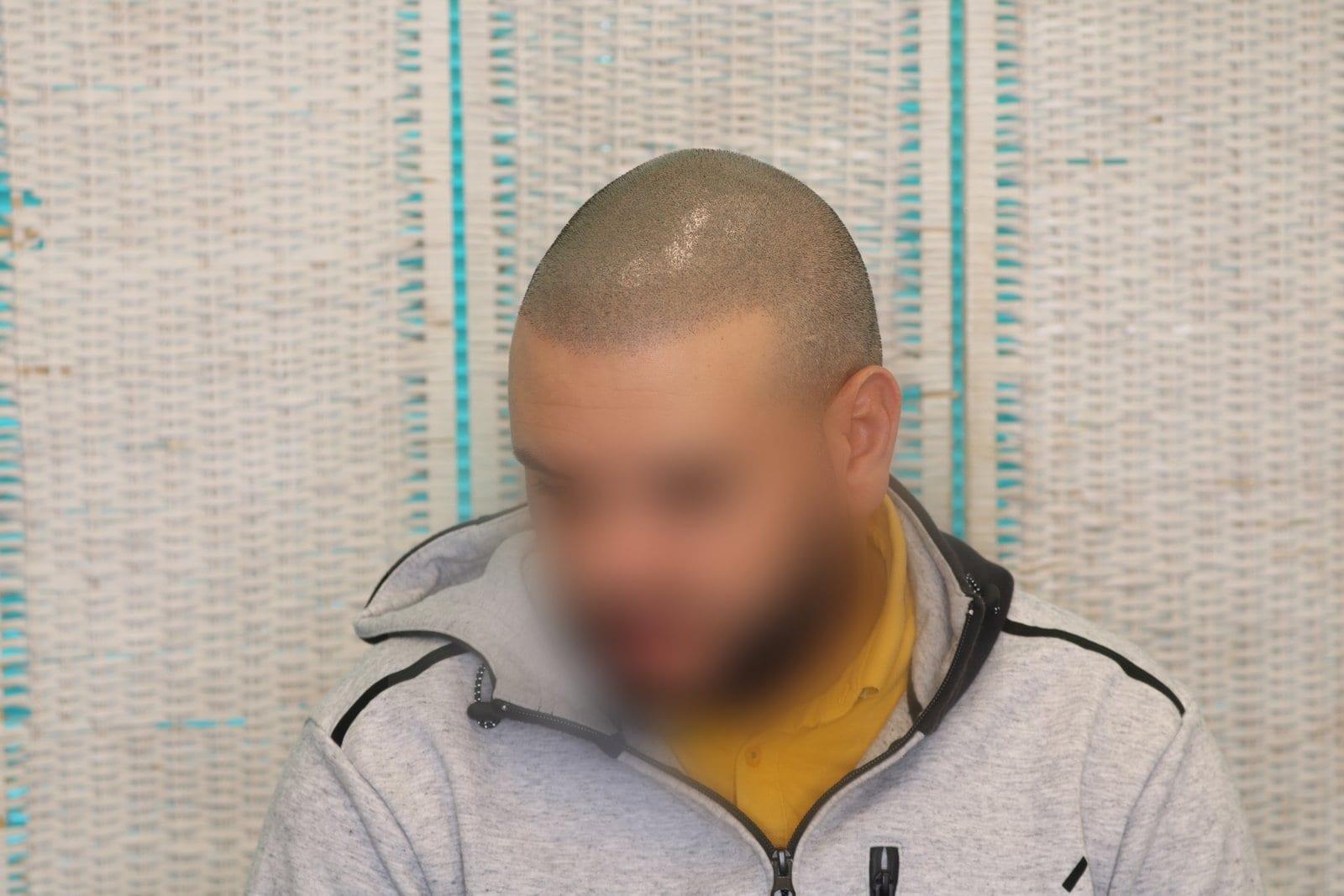 Dopo: tricopigmentazione effetto rasato a Firenze — Caso Prima / Dopo #26 (foto 5)
