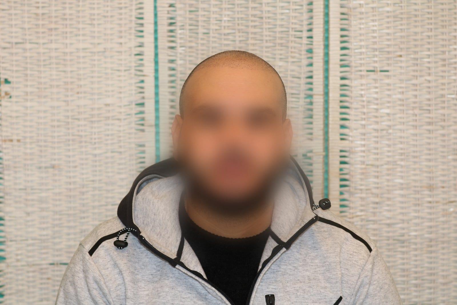 Prima: tricopigmentazione effetto rasato a Firenze — Caso Prima / Dopo #26 (foto 1)