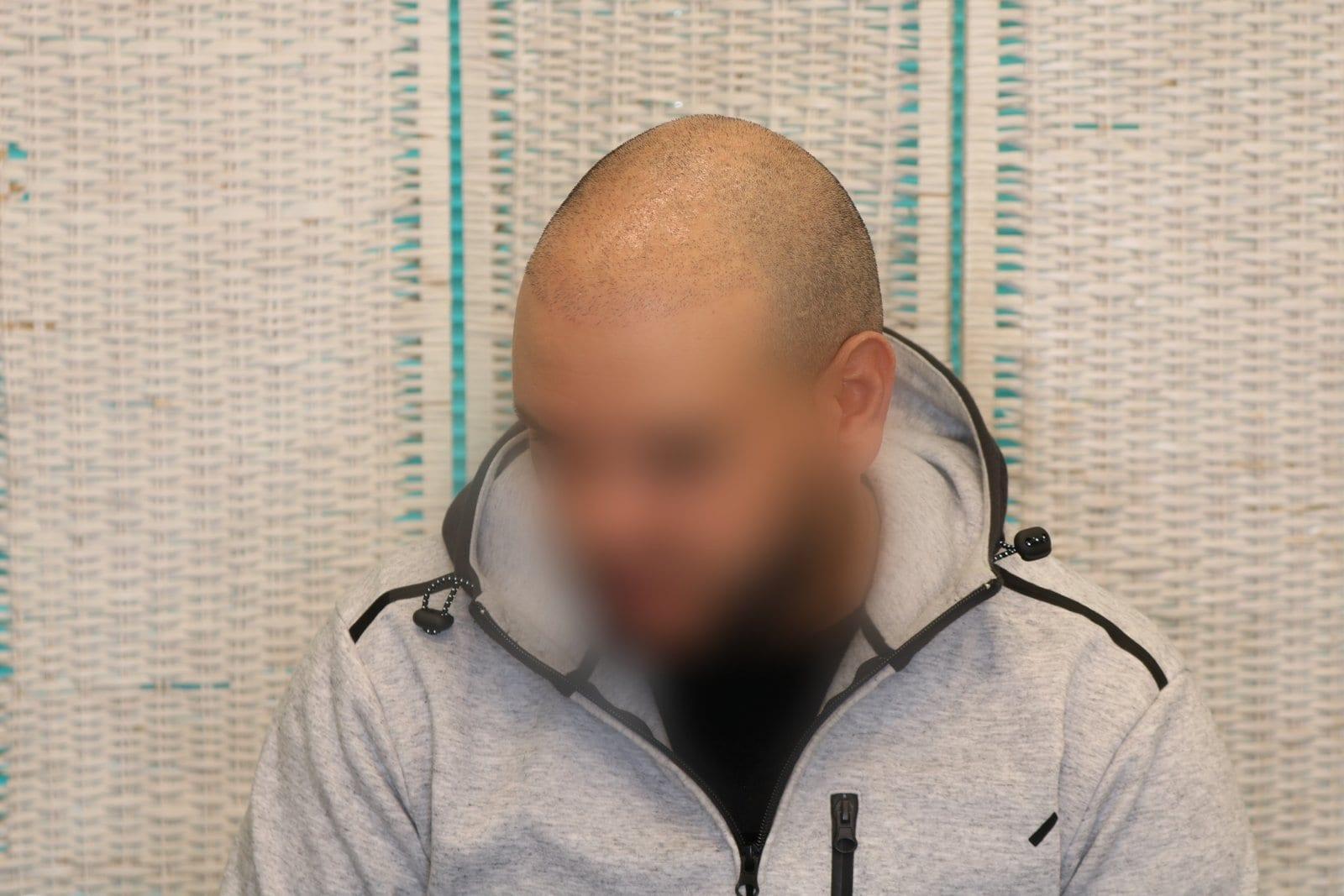 Prima: tricopigmentazione effetto rasato a Firenze — Caso Prima / Dopo #26 (foto 2)