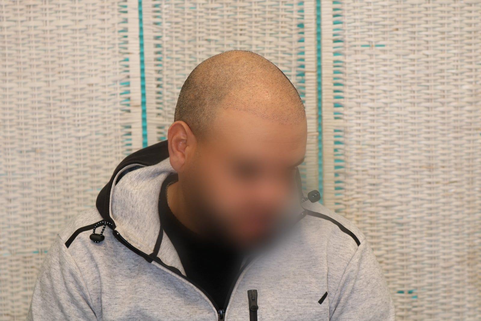 Prima: tricopigmentazione effetto rasato a Firenze — Caso Prima / Dopo #26 (foto 3)