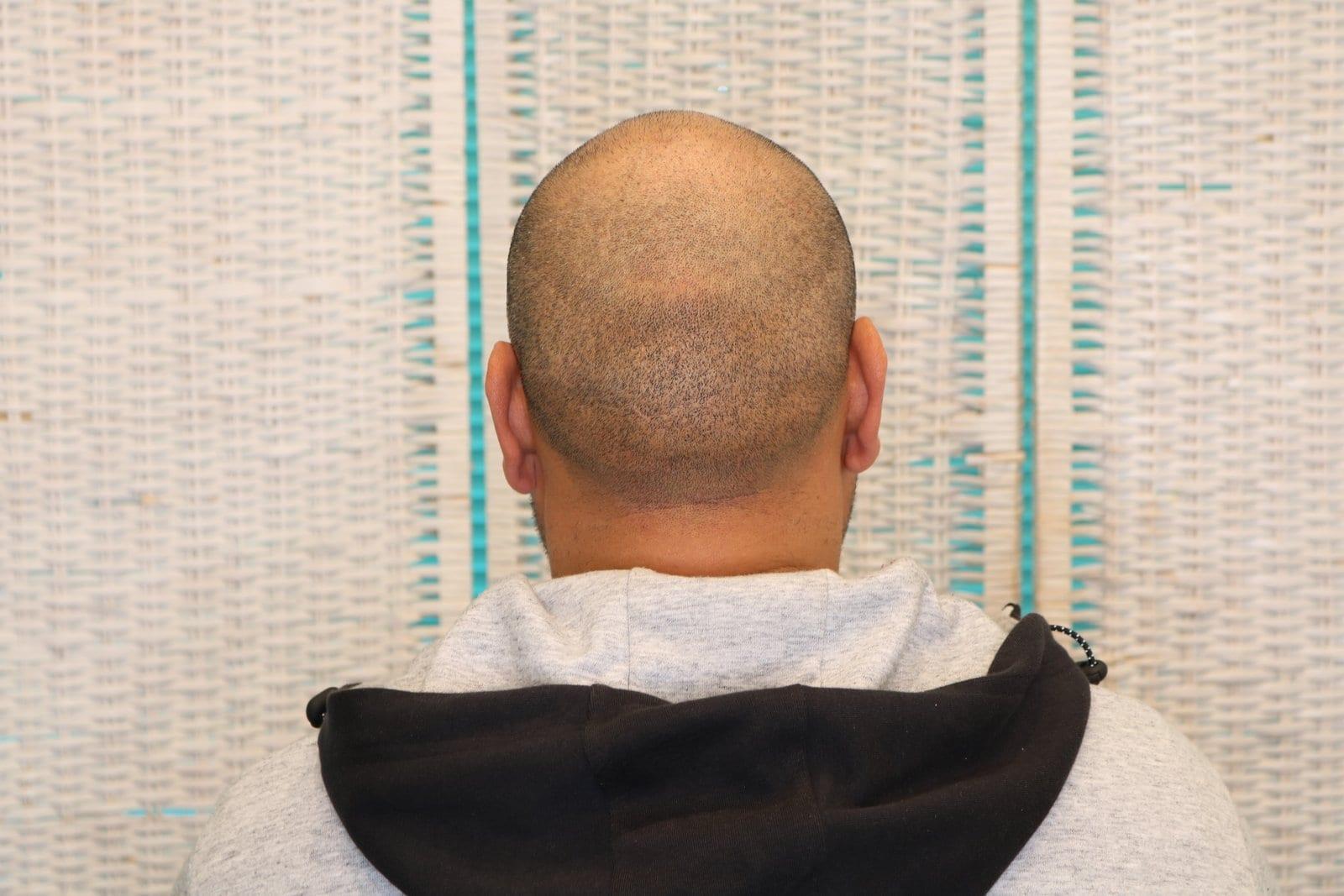 Prima: tricopigmentazione effetto rasato a Firenze — Caso Prima / Dopo #26 (foto 5)