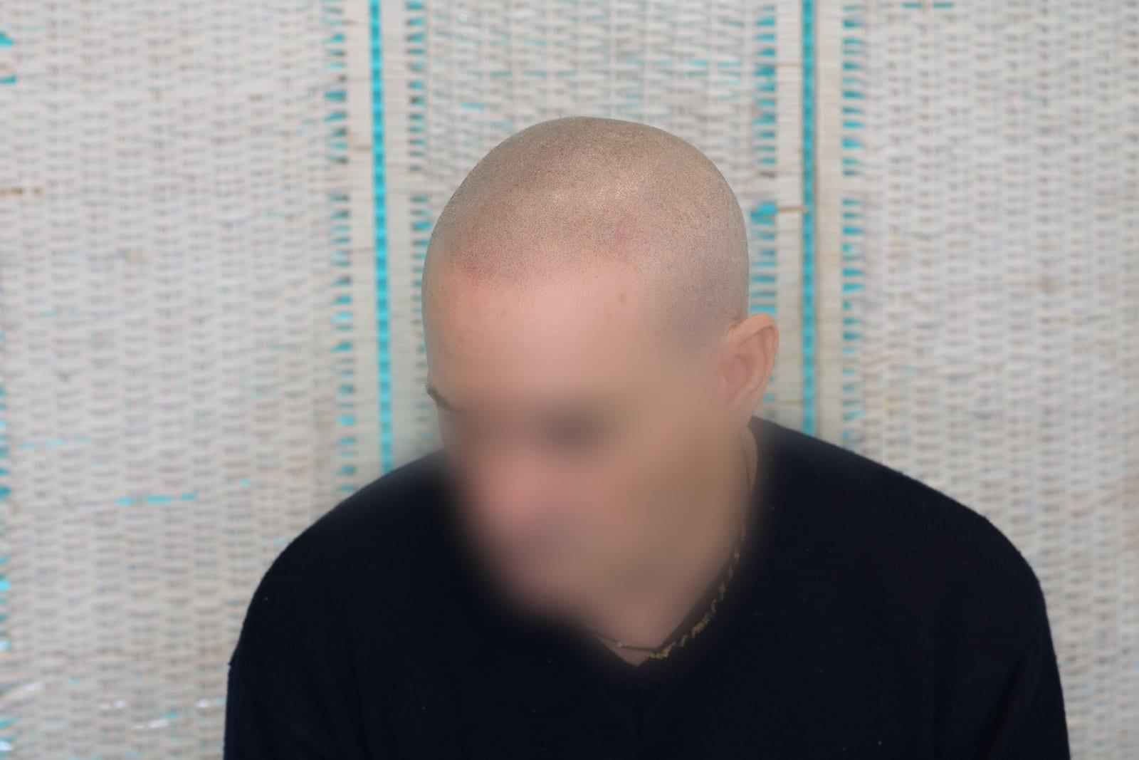 Dopo: tricopigmentazione effetto rasato a Firenze — Caso Prima / Dopo #27 (foto 2)