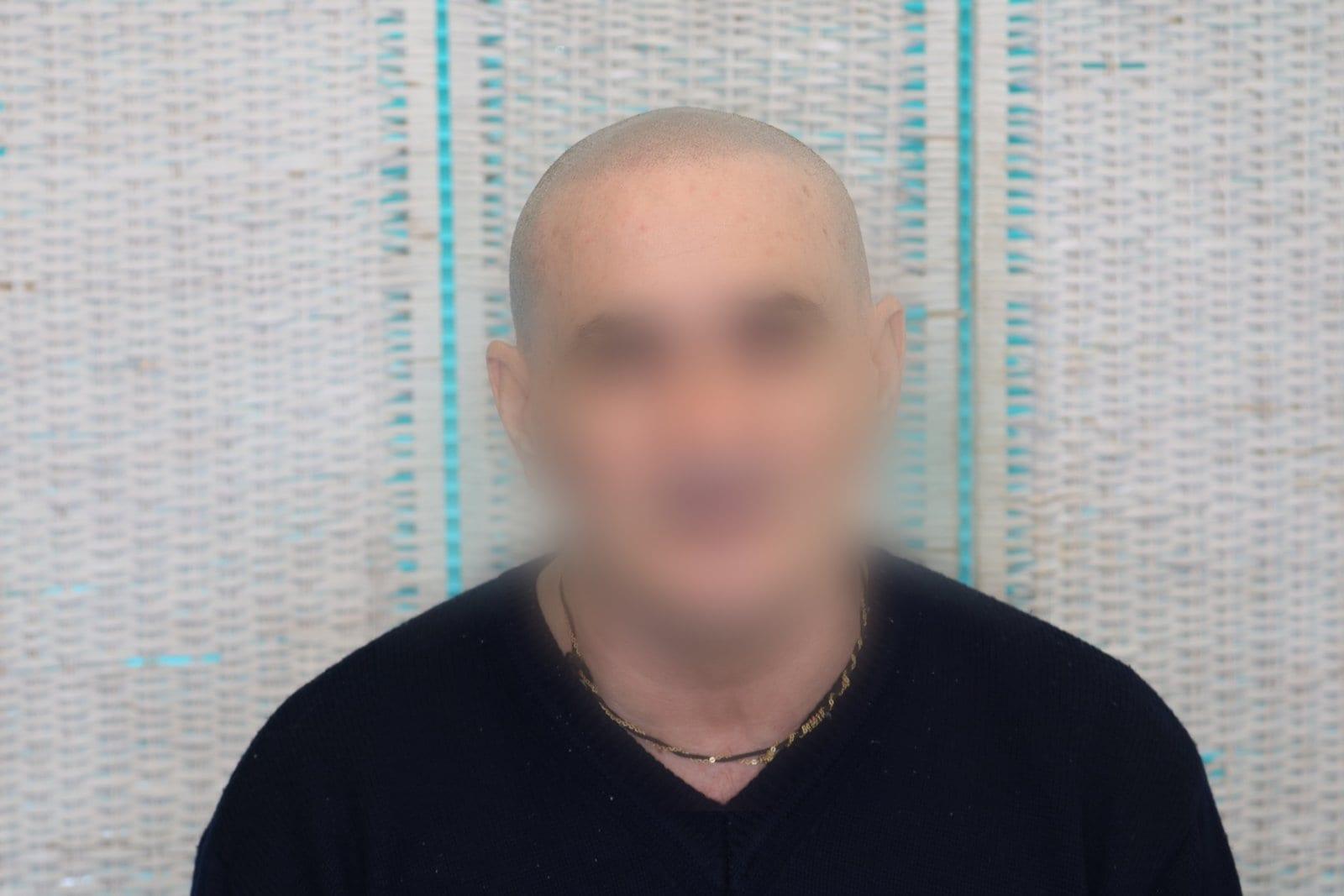Dopo: tricopigmentazione effetto rasato a Firenze — Caso Prima / Dopo #27 (foto 3)