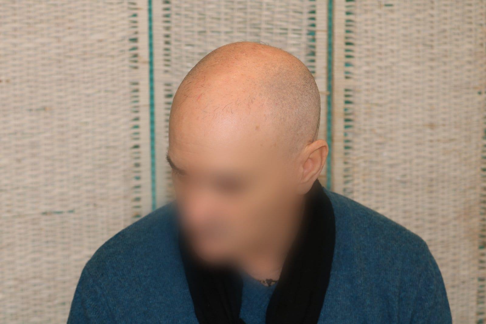 Prima: tricopigmentazione effetto rasato a Firenze — Caso Prima / Dopo #27 (foto 1)