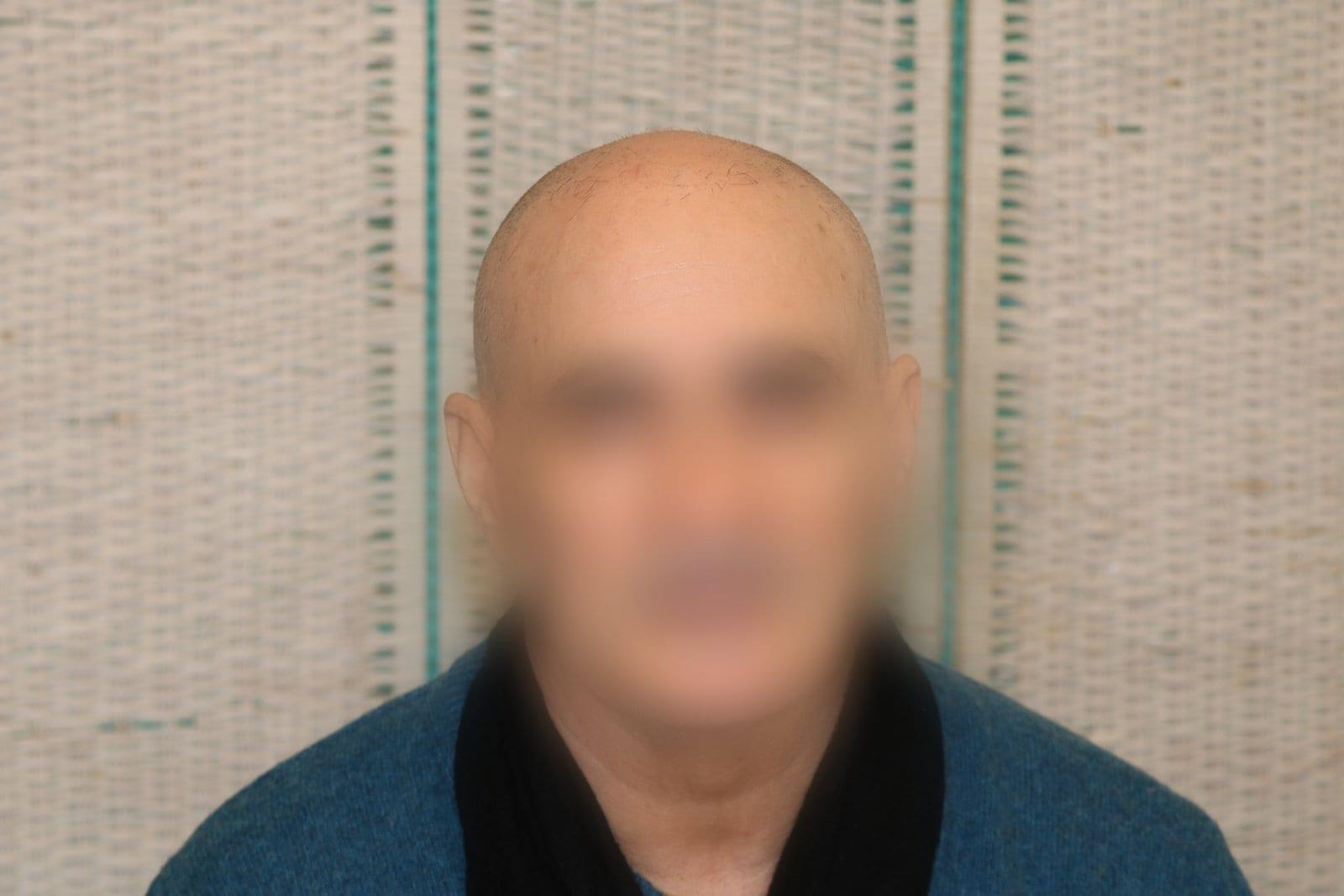 Prima: tricopigmentazione effetto rasato a Firenze — Caso Prima / Dopo #27 (foto 2)
