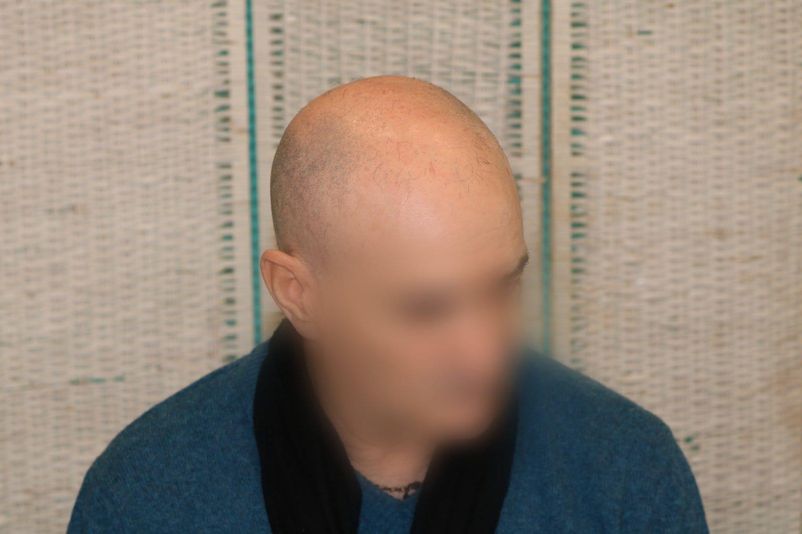 Prima: tricopigmentazione effetto rasato a Firenze — Caso Prima / Dopo #27 (foto 3)