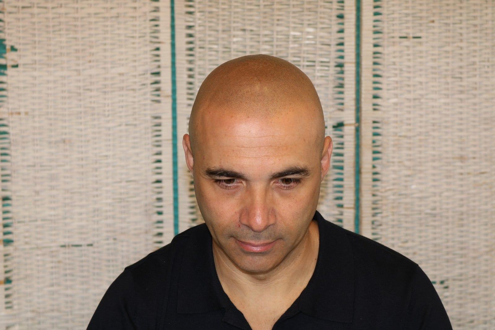 Dopo: tricopigmentazione effetto rasato a Firenze — Caso Prima / Dopo #29 (foto 5)
