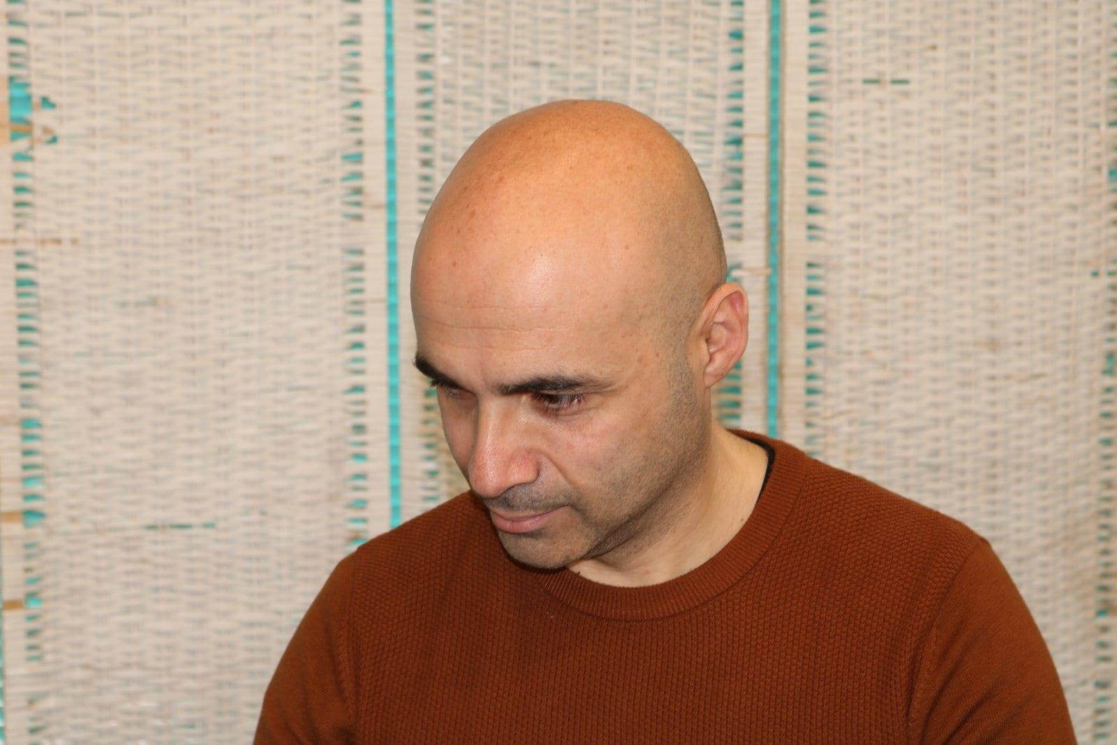 Prima: tricopigmentazione effetto rasato a Firenze — Caso Prima / Dopo #29 (foto 2)