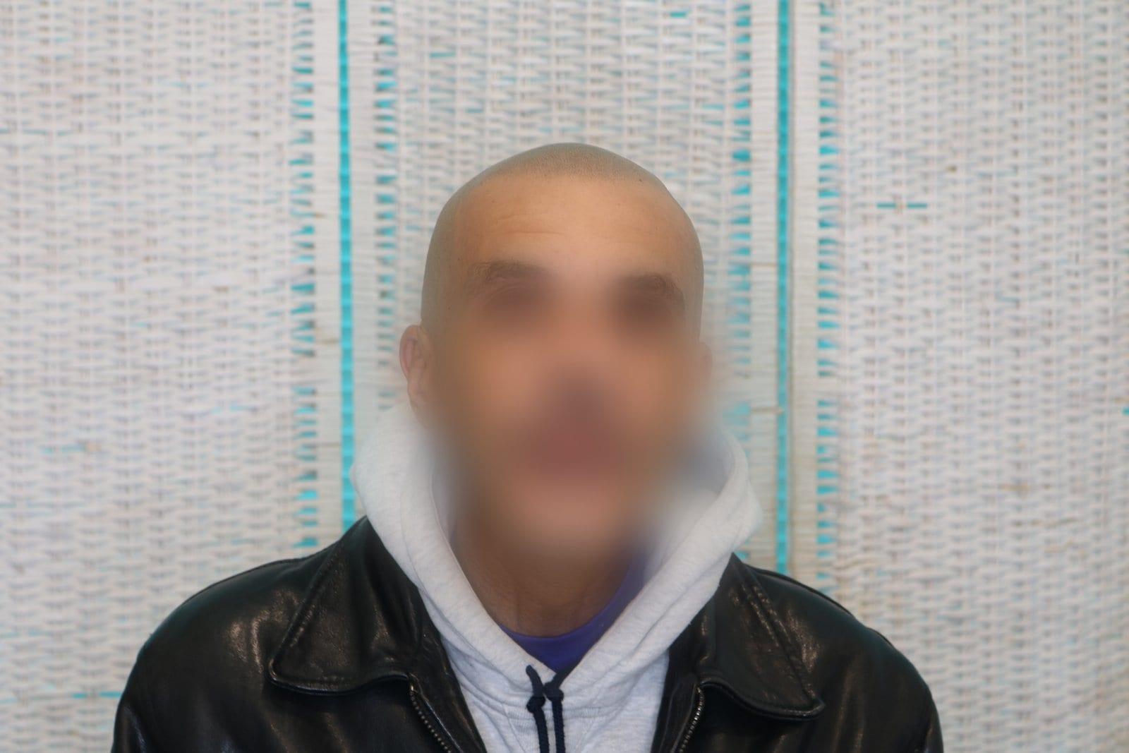 Tricopigmentazione, dopo, caso #30, Firenze