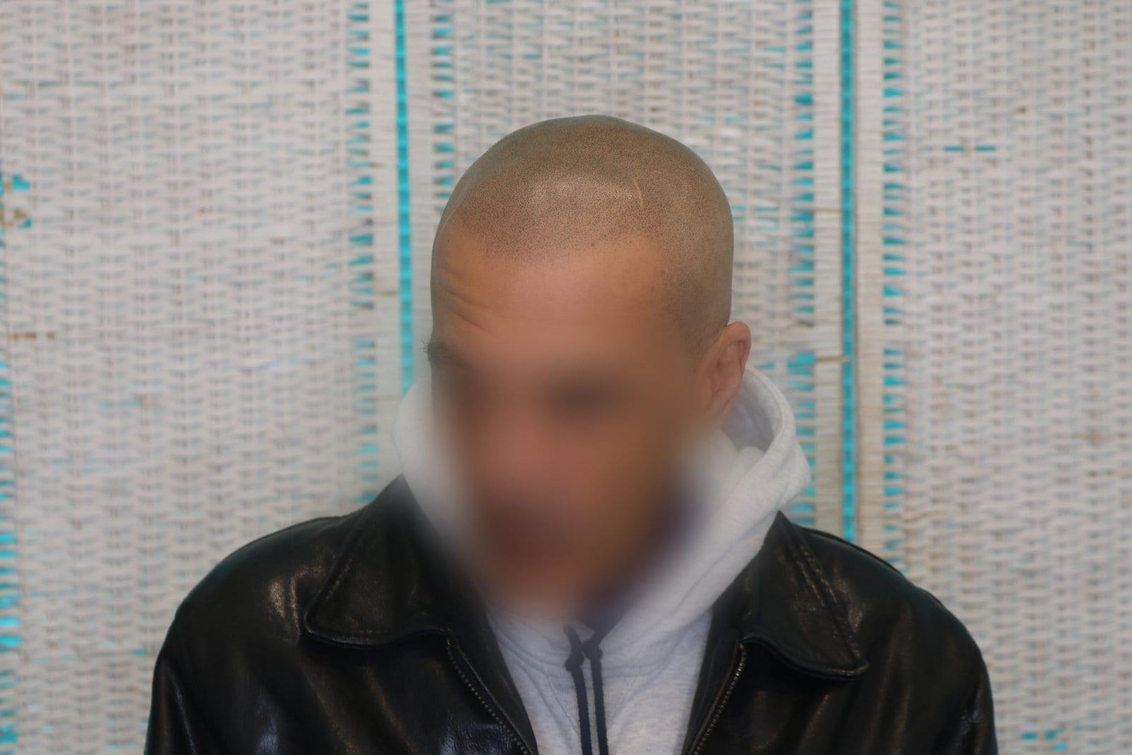 Dopo: tricopigmentazione effetto rasato a Firenze — Caso Prima / Dopo #30 (foto 2)
