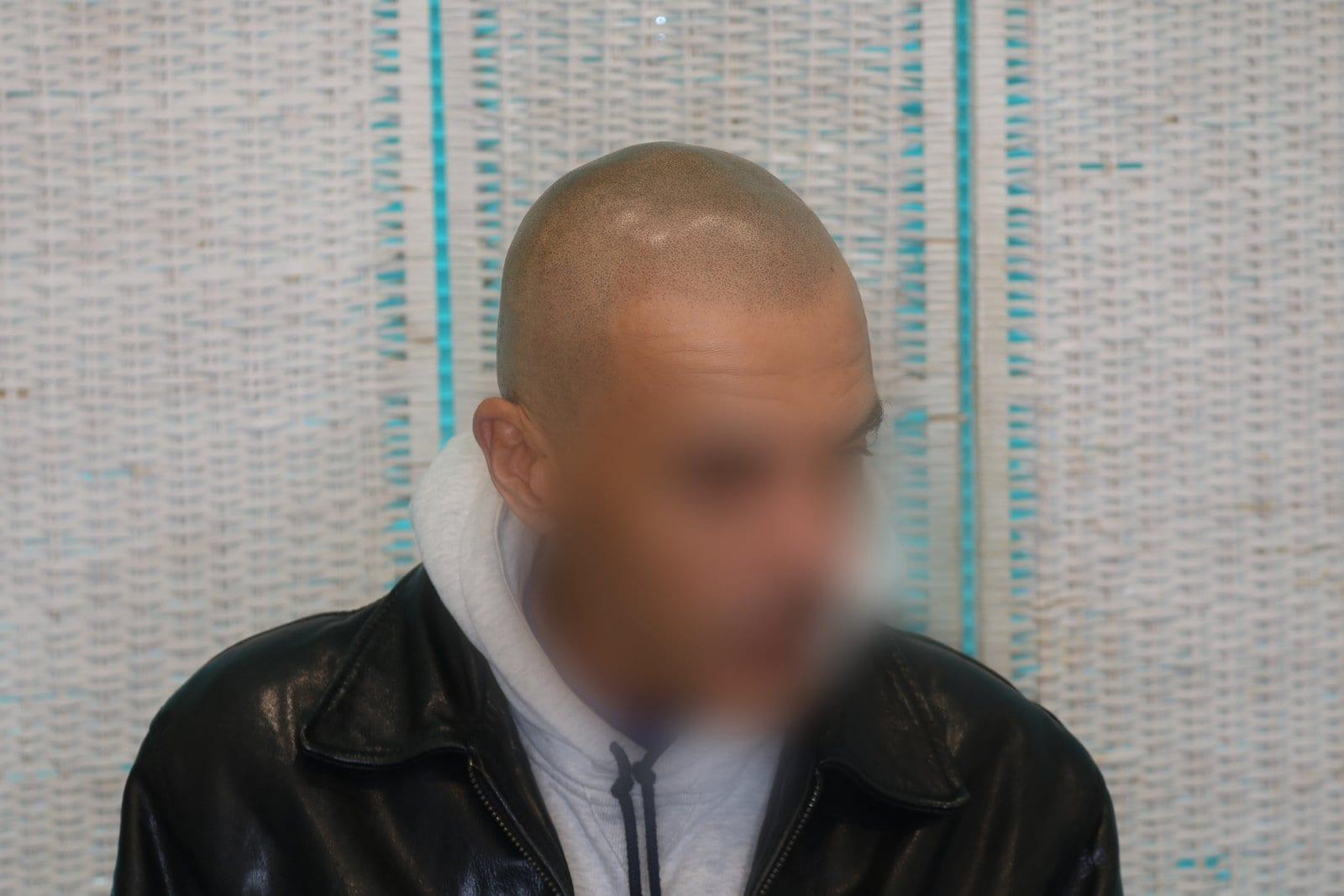Dopo: tricopigmentazione effetto rasato a Firenze — Caso Prima / Dopo #30 (foto 3)