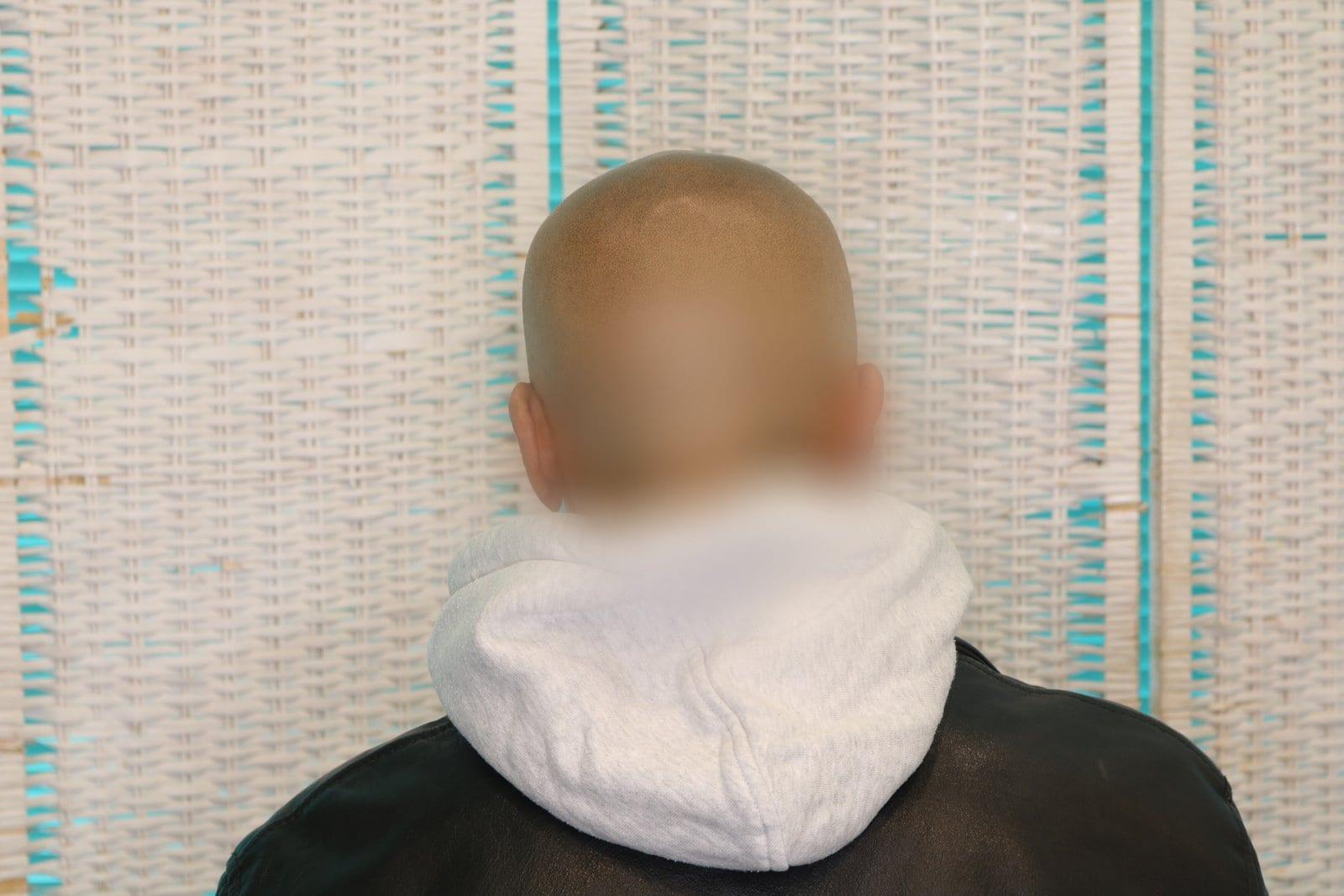 Dopo: tricopigmentazione effetto rasato a Firenze — Caso Prima / Dopo #30 (foto 4)