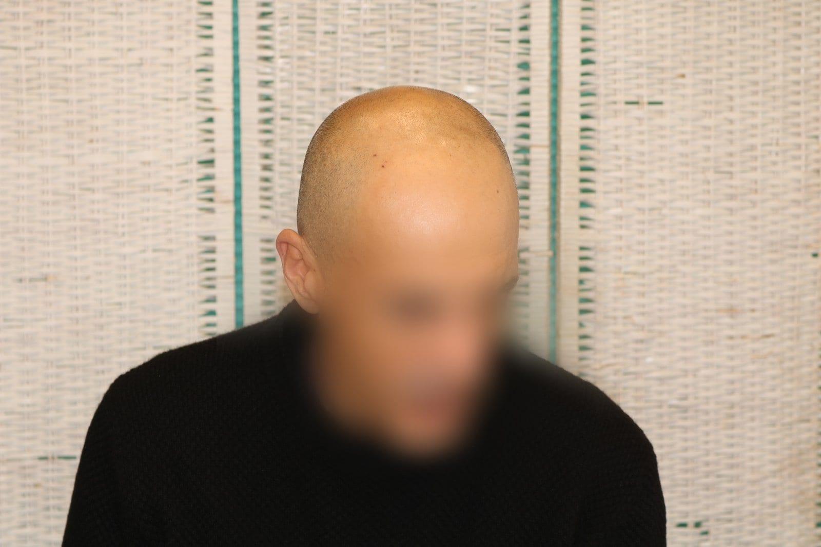 Prima: tricopigmentazione effetto rasato a Firenze — Caso Prima / Dopo #30 (foto 1)