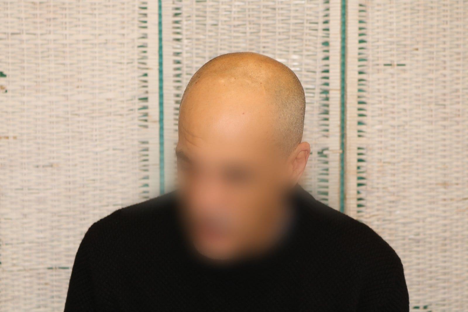Prima: tricopigmentazione effetto rasato a Firenze — Caso Prima / Dopo #30 (foto 2)