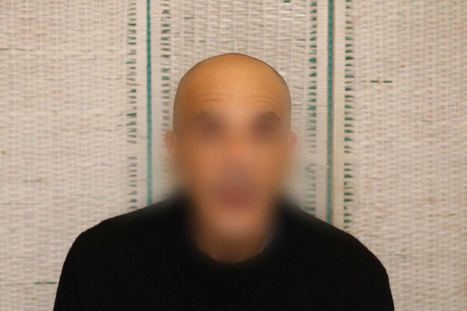 Prima: tricopigmentazione effetto rasato a Firenze — Caso Prima / Dopo #30 (foto 4)