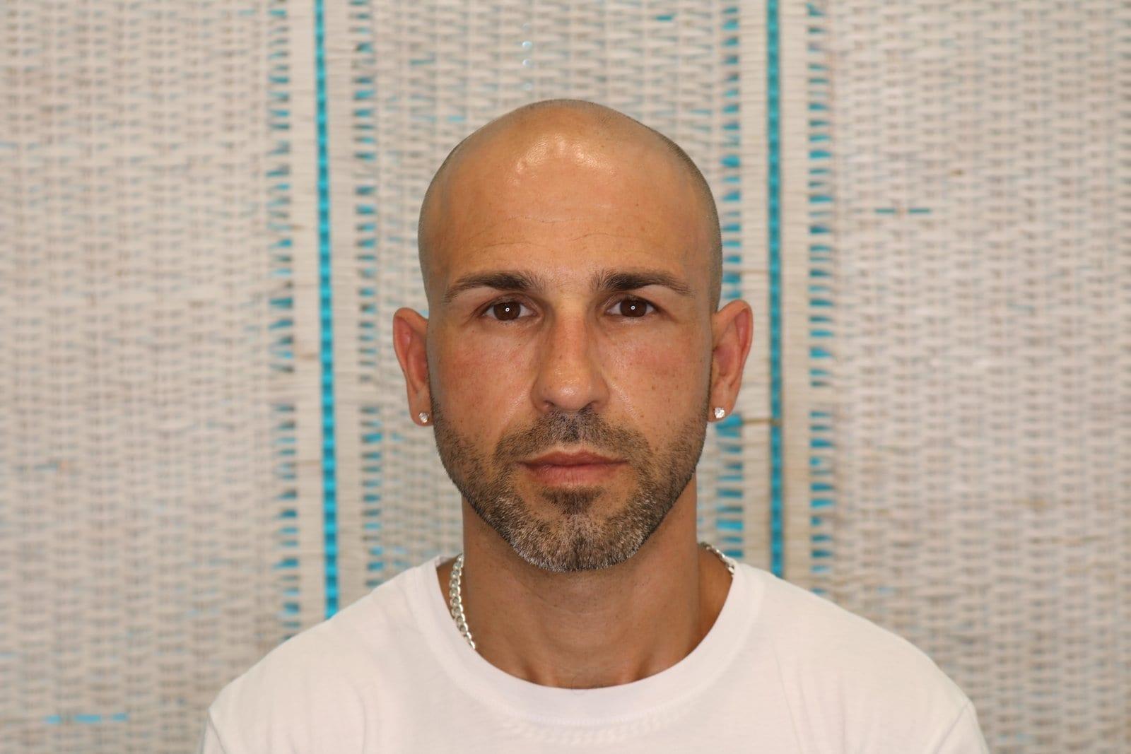 Prima: tricopigmentazione effetto rasato a Firenze — Caso Prima / Dopo #31 (foto 1)