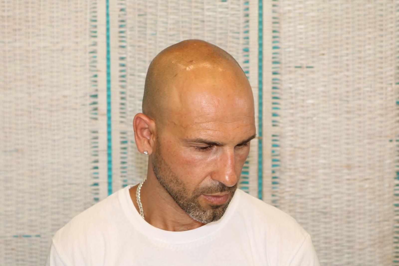 Prima: tricopigmentazione effetto rasato a Firenze — Caso Prima / Dopo #31 (foto 2)