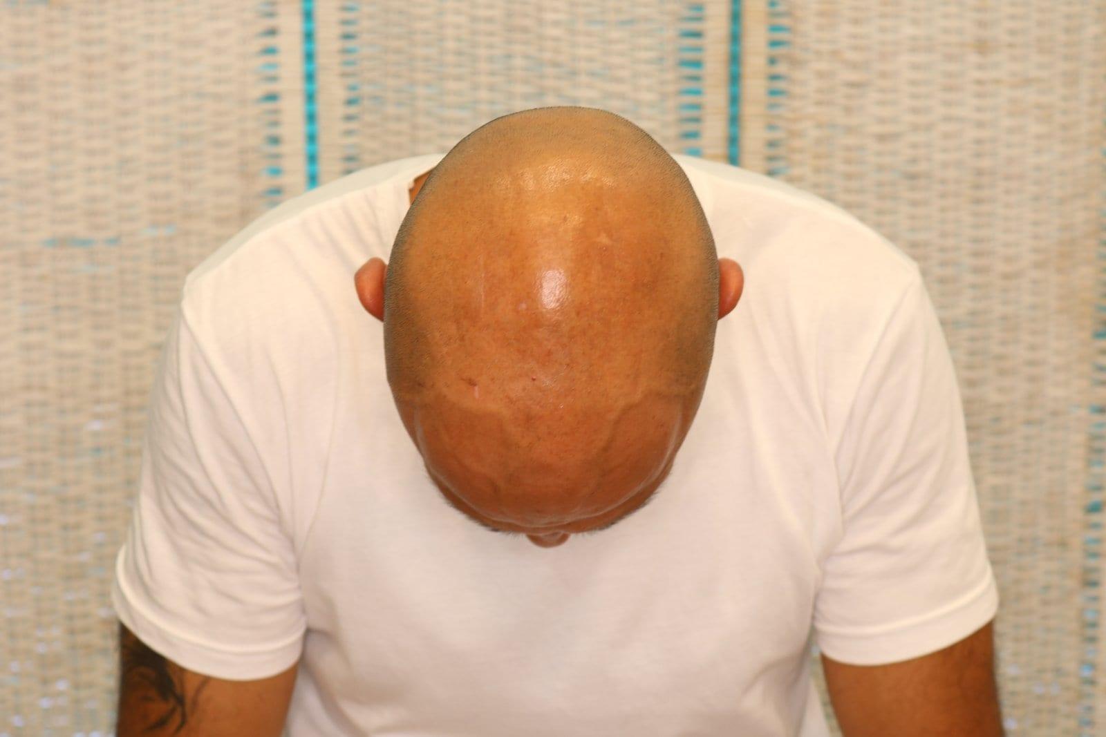 Prima: tricopigmentazione effetto rasato a Firenze — Caso Prima / Dopo #31 (foto 3)