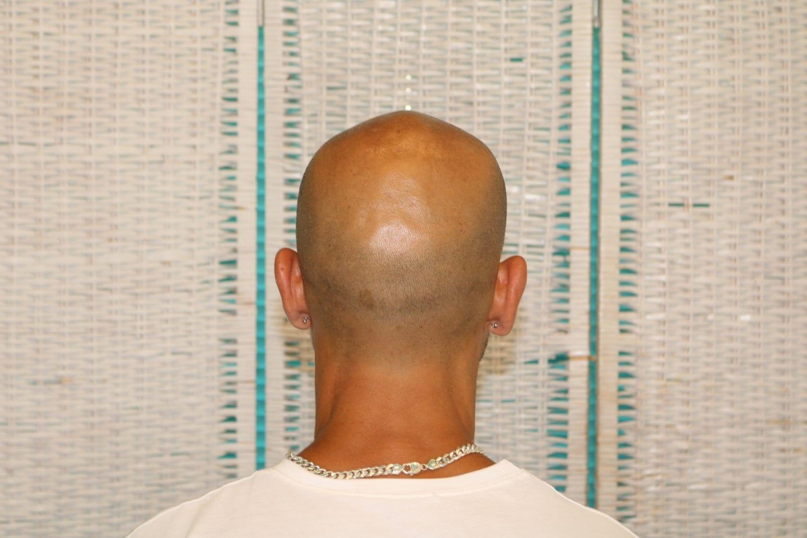 Prima: tricopigmentazione effetto rasato a Firenze — Caso Prima / Dopo #31 (foto 4)