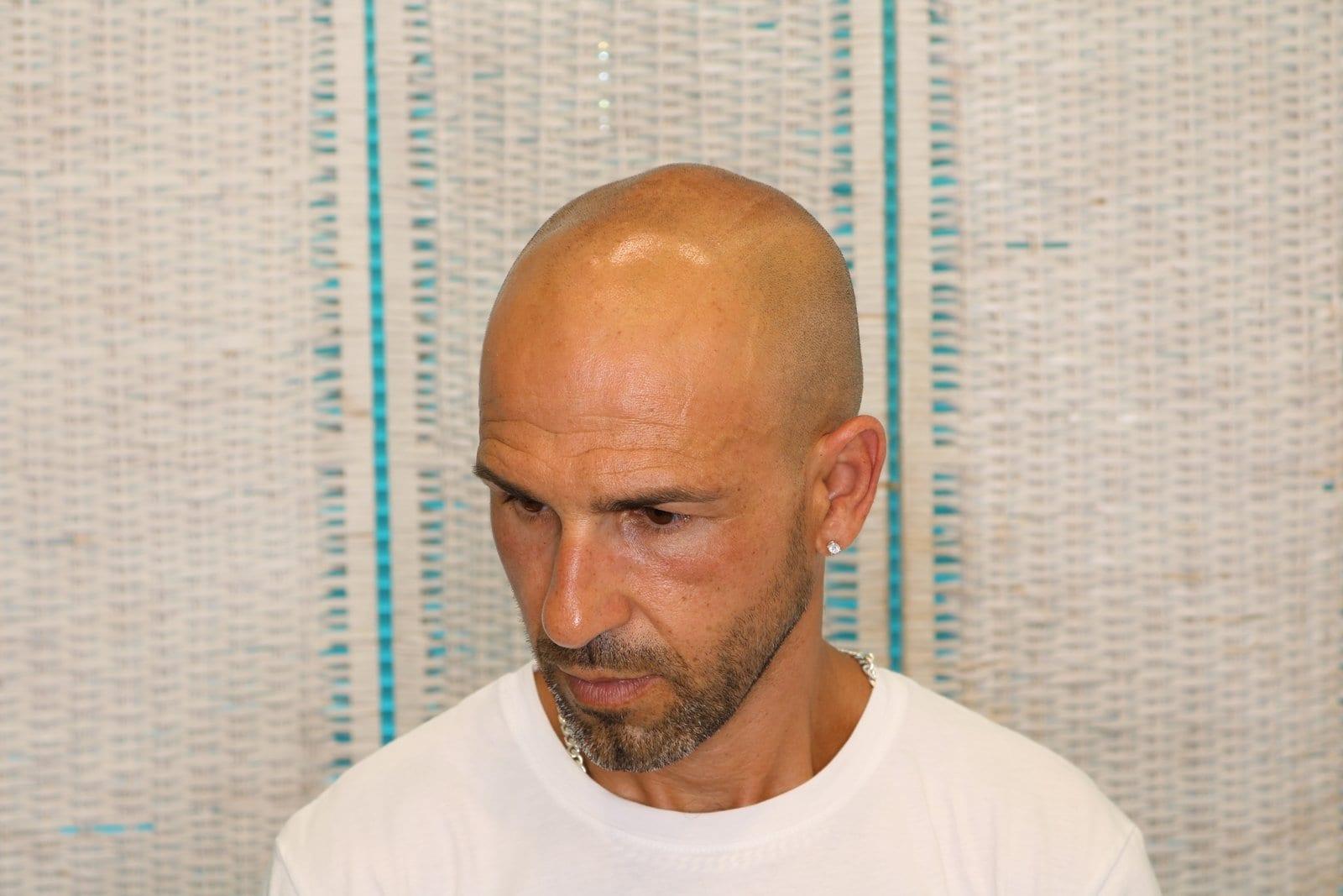 Prima: tricopigmentazione effetto rasato a Firenze — Caso Prima / Dopo #31 (foto 5)