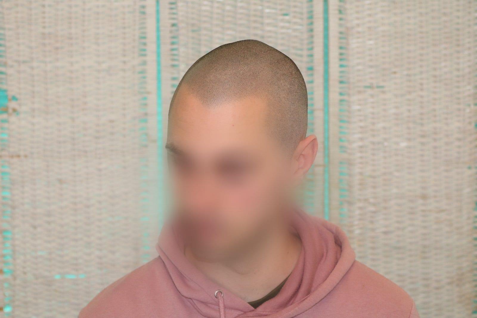 Dopo: tricopigmentazione effetto rasato a Firenze — Caso Prima / Dopo #32 (foto 2)
