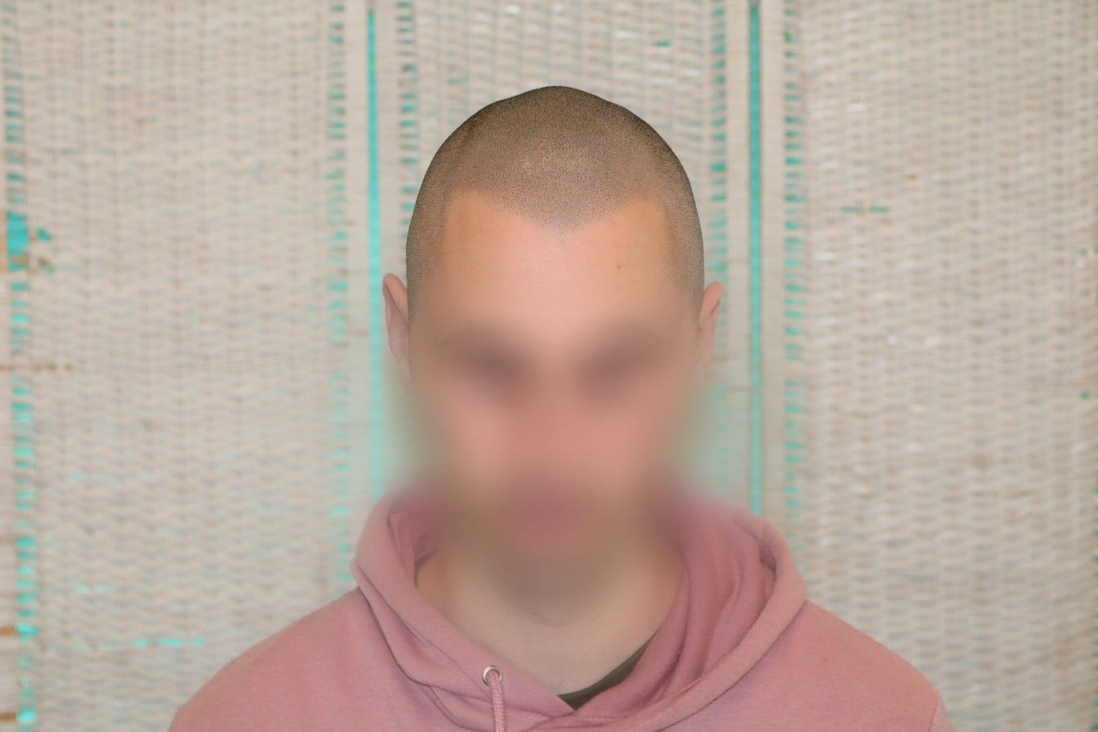 Dopo: tricopigmentazione effetto rasato a Firenze — Caso Prima / Dopo #32 (foto 3)