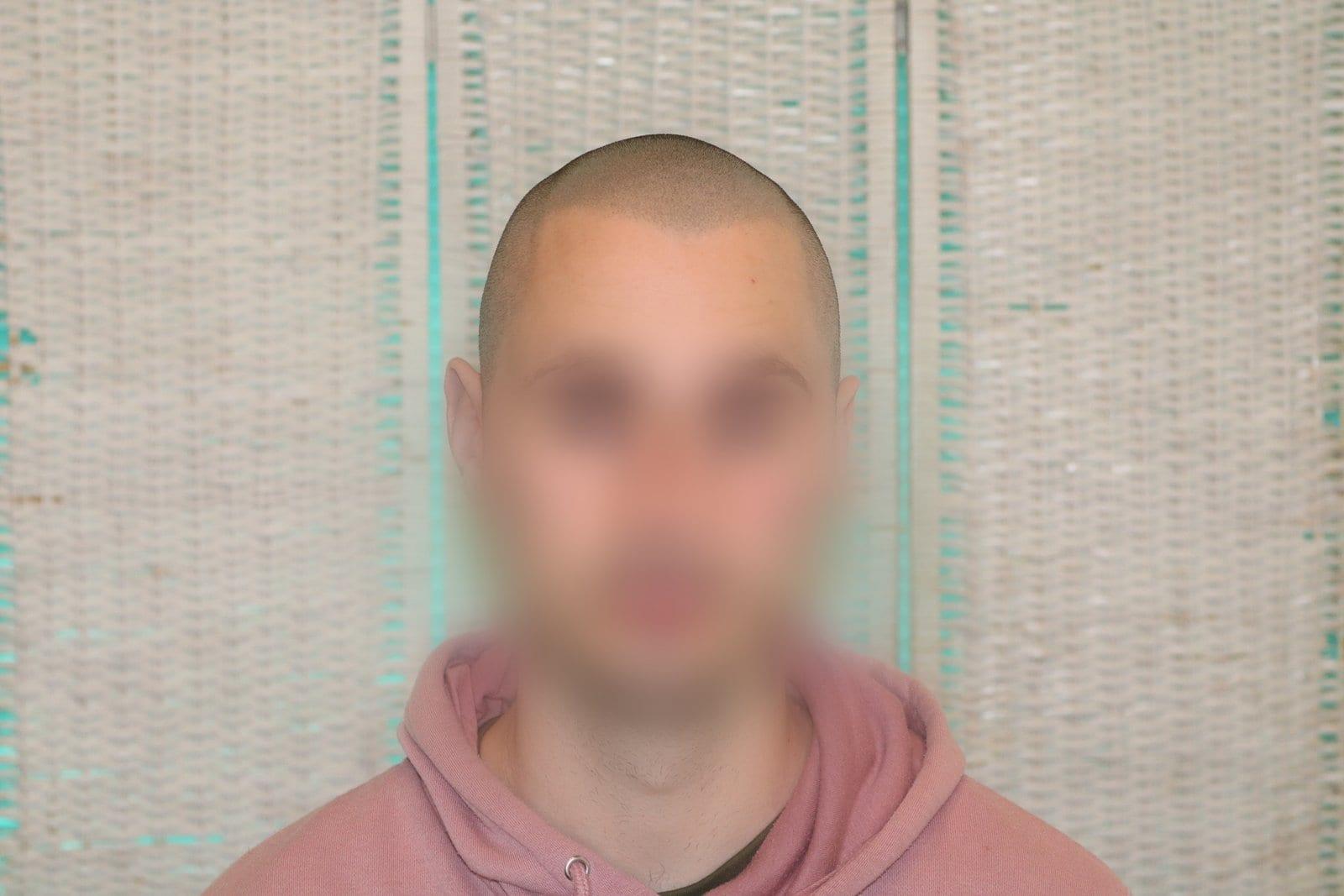Dopo: tricopigmentazione effetto rasato a Firenze — Caso Prima / Dopo #32 (foto 4)