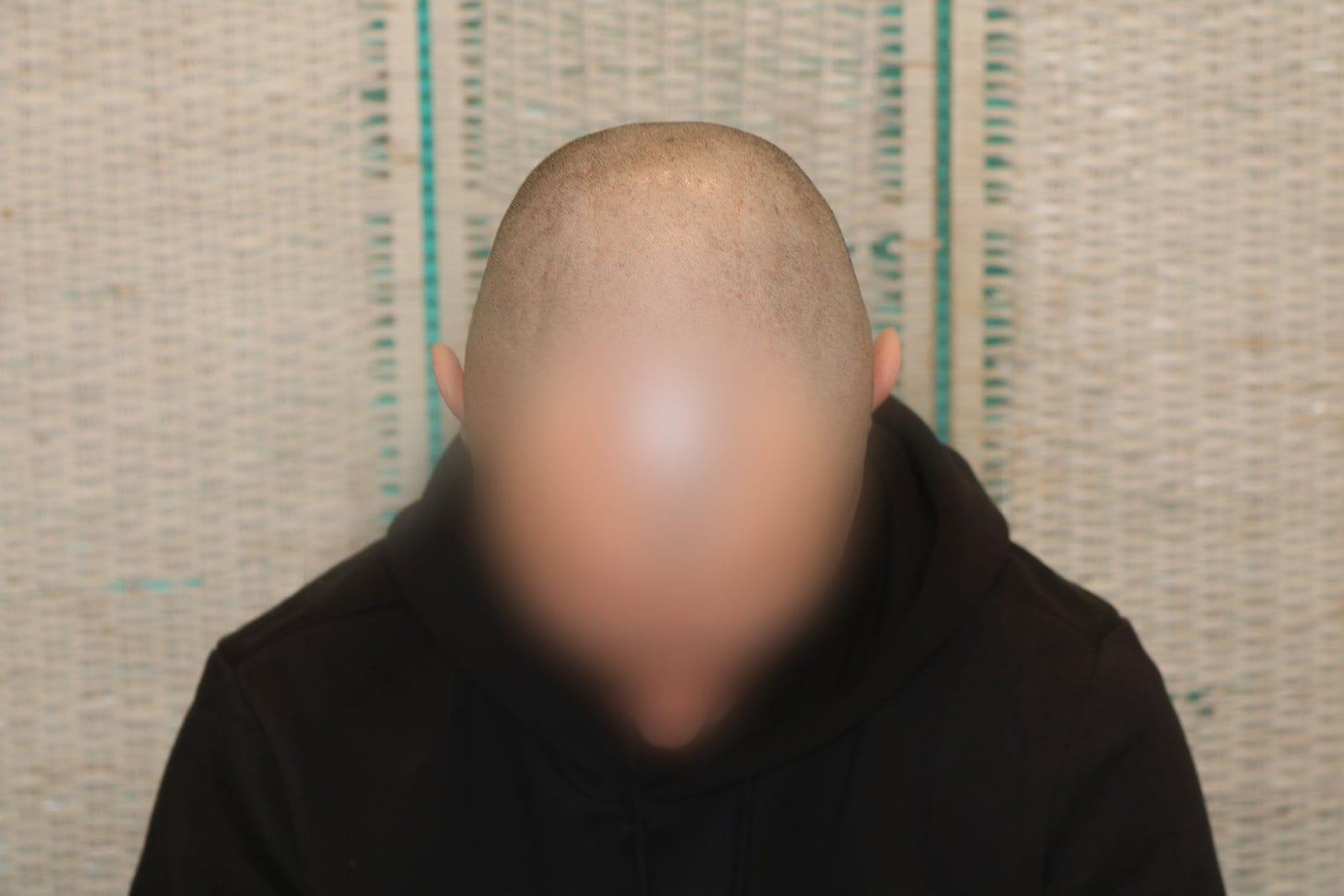 Prima: tricopigmentazione effetto rasato a Firenze — Caso Prima / Dopo #32 (foto 1)