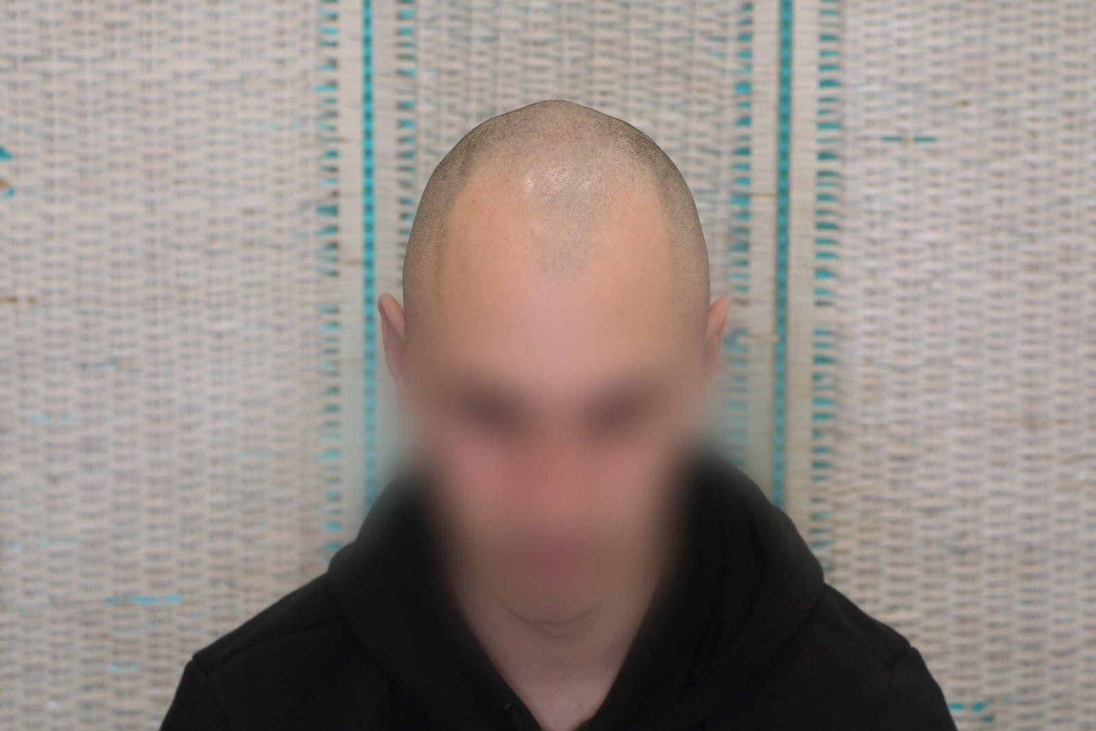 Prima: tricopigmentazione effetto rasato a Firenze — Caso Prima / Dopo #32 (foto 2)