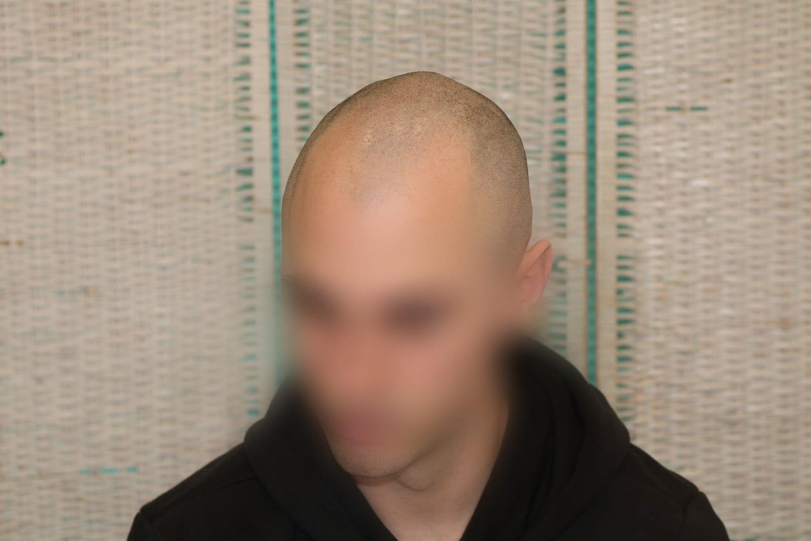 Prima: tricopigmentazione effetto rasato a Firenze — Caso Prima / Dopo #32 (foto 3)