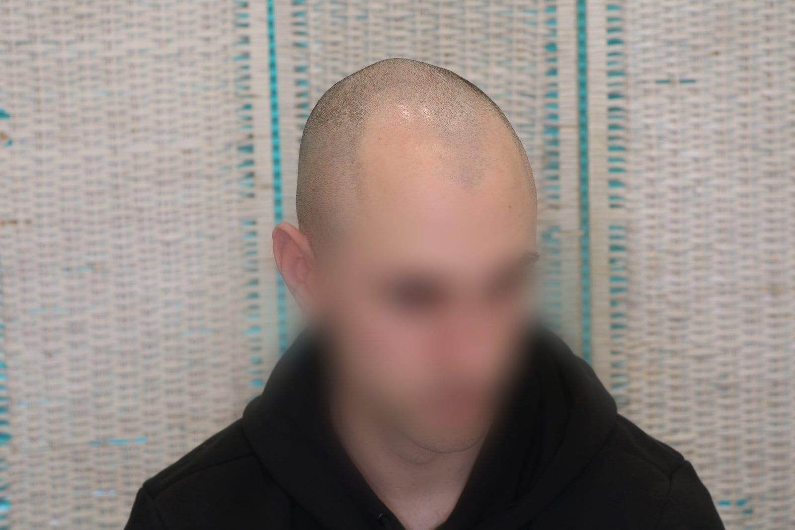 Prima: tricopigmentazione effetto rasato a Firenze — Caso Prima / Dopo #32 (foto 4)