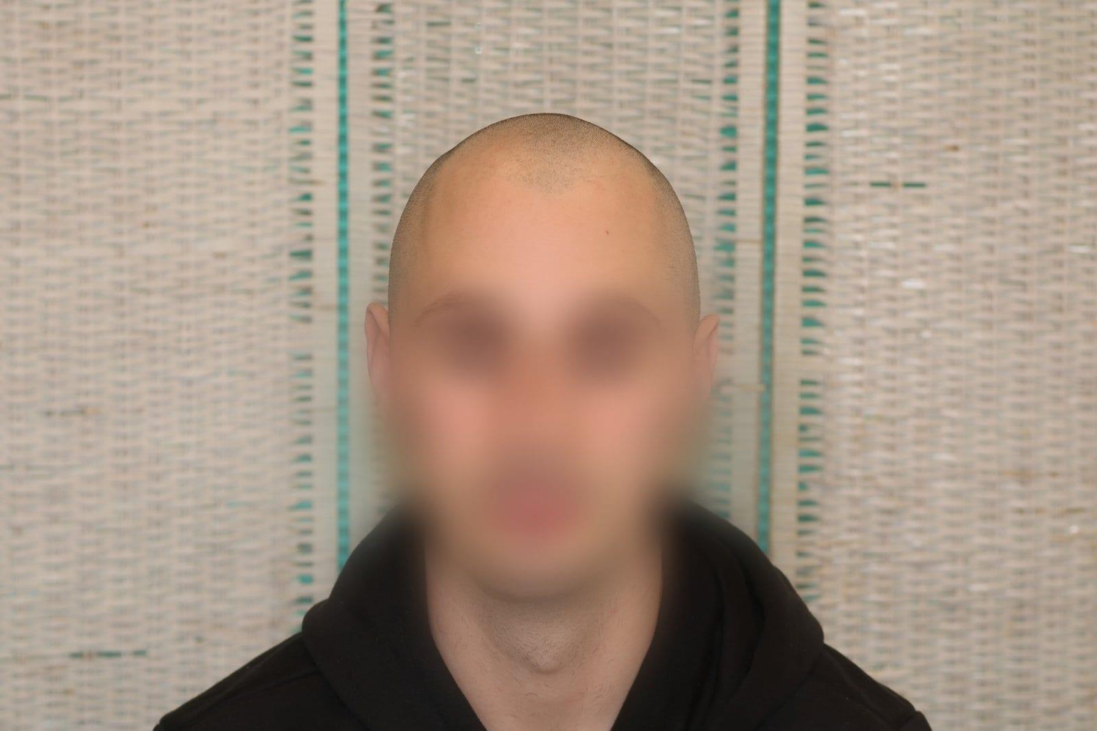 Prima: tricopigmentazione effetto rasato a Firenze — Caso Prima / Dopo #32 (foto 5)