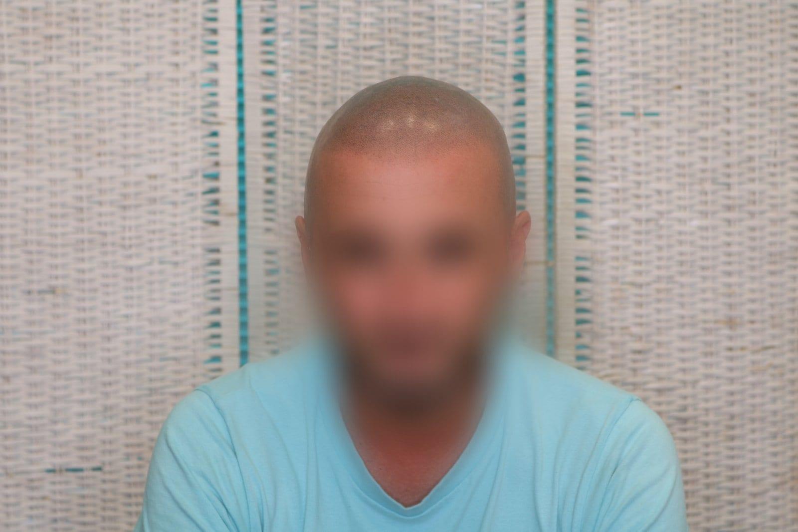 Tricopigmentazione, dopo, caso #33, Firenze