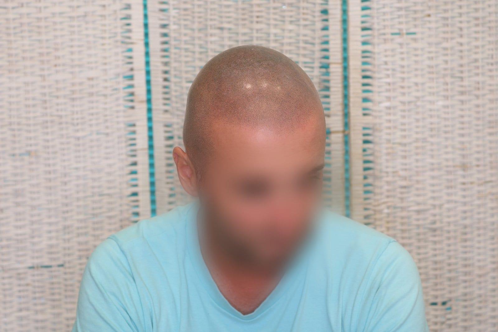 Dopo: tricopigmentazione effetto rasato a Firenze — Caso Prima / Dopo #33 (foto 2)