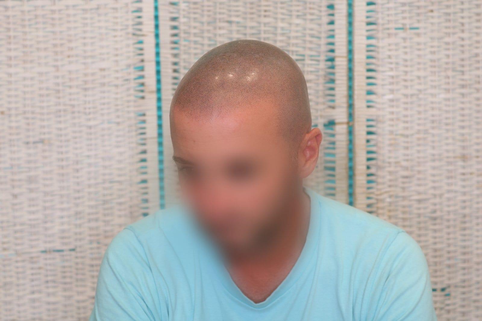 Dopo: tricopigmentazione effetto rasato a Firenze — Caso Prima / Dopo #33 (foto 4)