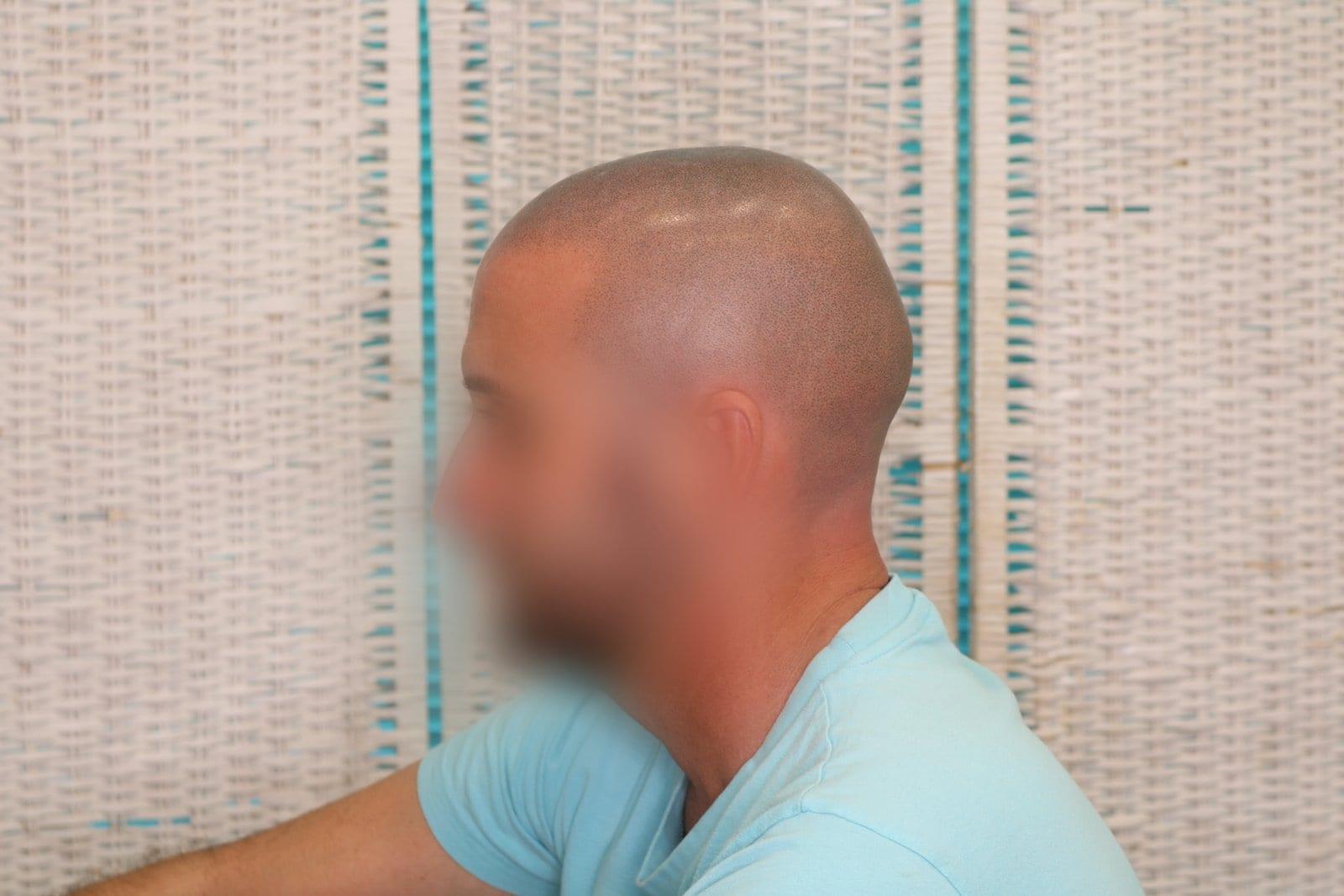 Dopo: tricopigmentazione effetto rasato a Firenze — Caso Prima / Dopo #33 (foto 5)