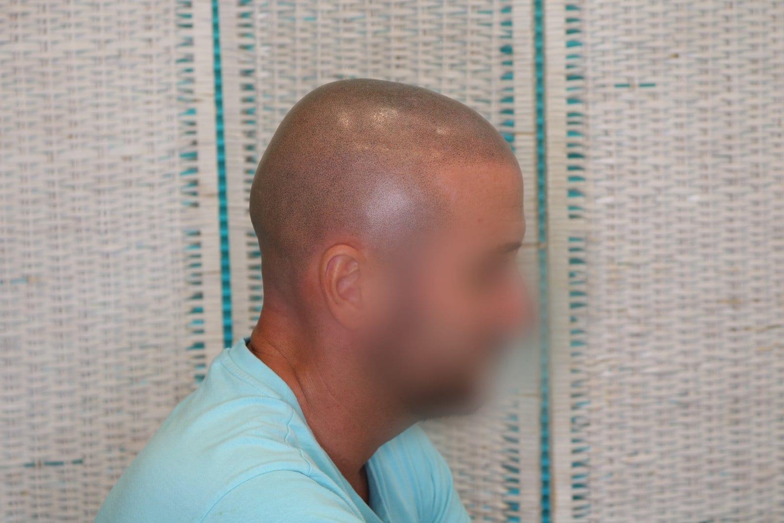 Dopo: tricopigmentazione effetto rasato a Firenze — Caso Prima / Dopo #33 (foto 6)