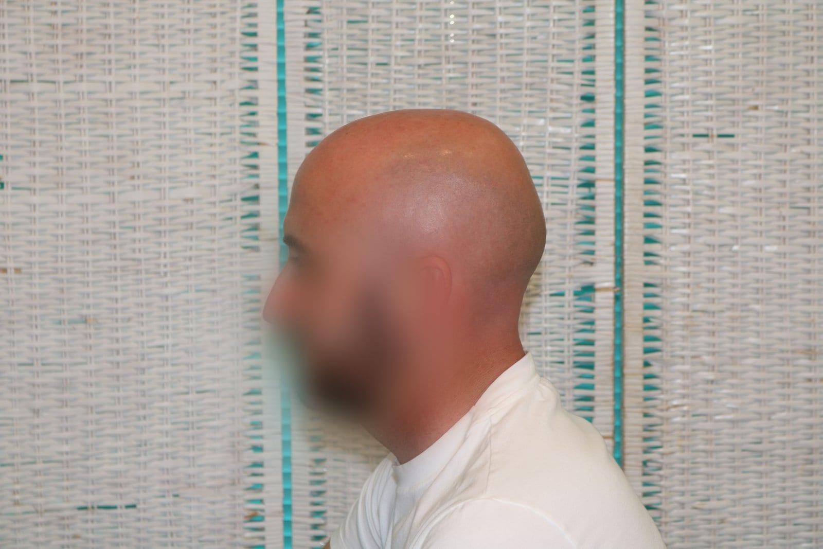 Prima: tricopigmentazione effetto rasato a Firenze — Caso Prima / Dopo #33 (foto 1)