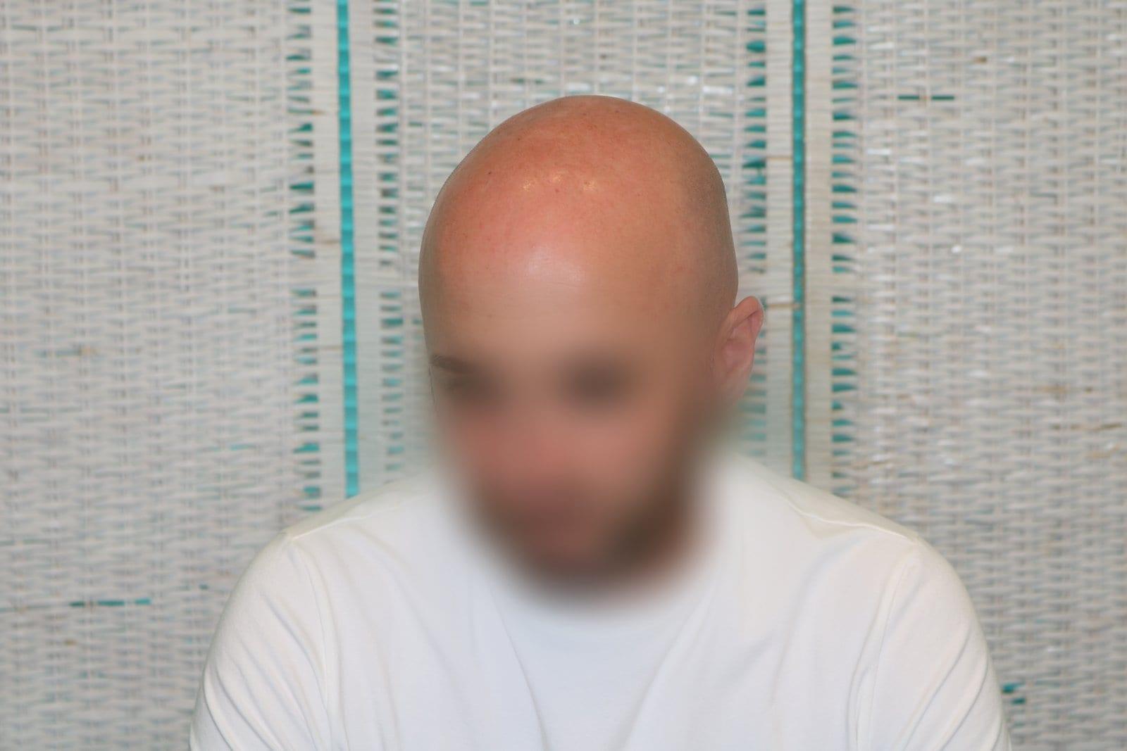 Prima: tricopigmentazione effetto rasato a Firenze — Caso Prima / Dopo #33 (foto 3)