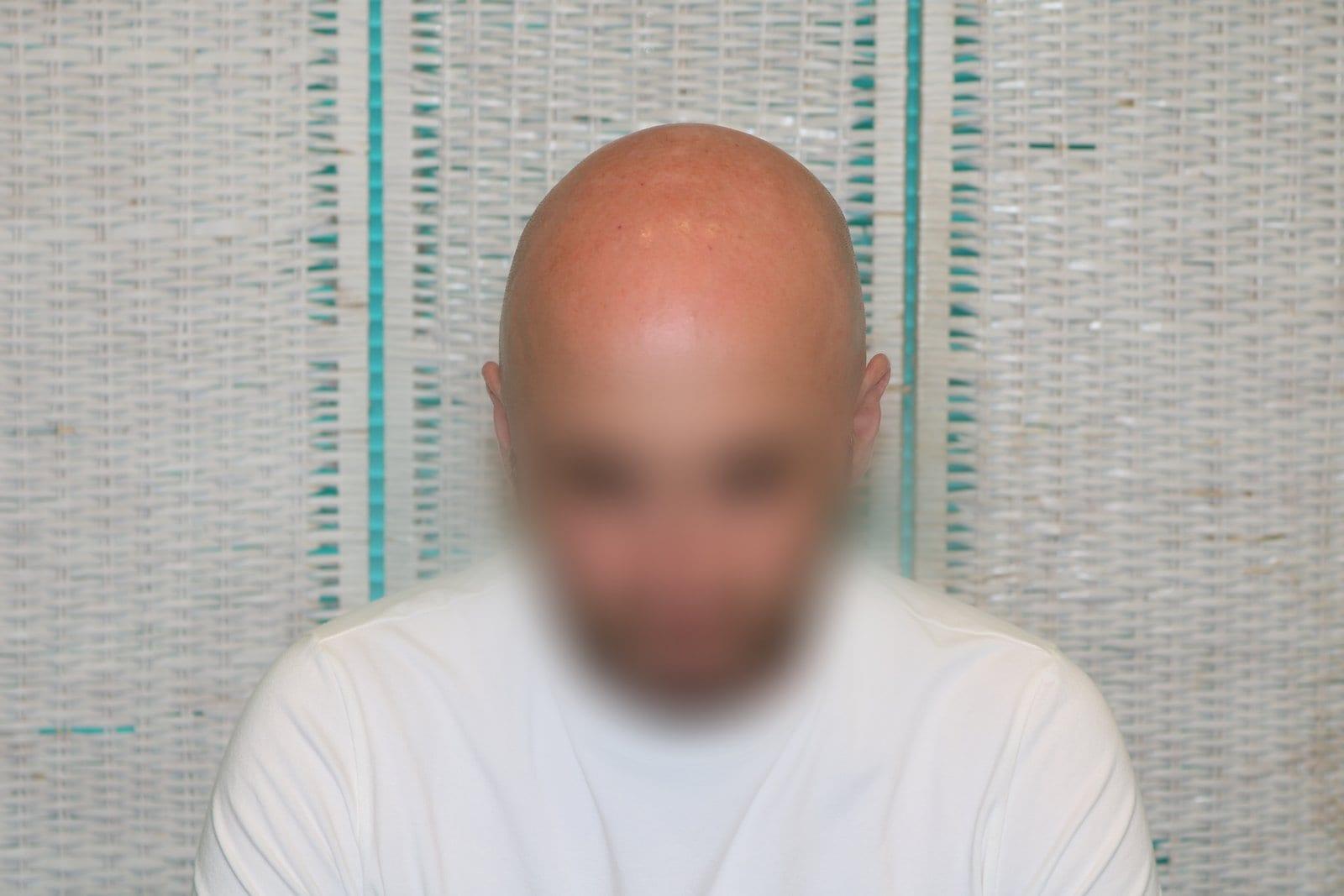 Prima: tricopigmentazione effetto rasato a Firenze — Caso Prima / Dopo #33 (foto 4)