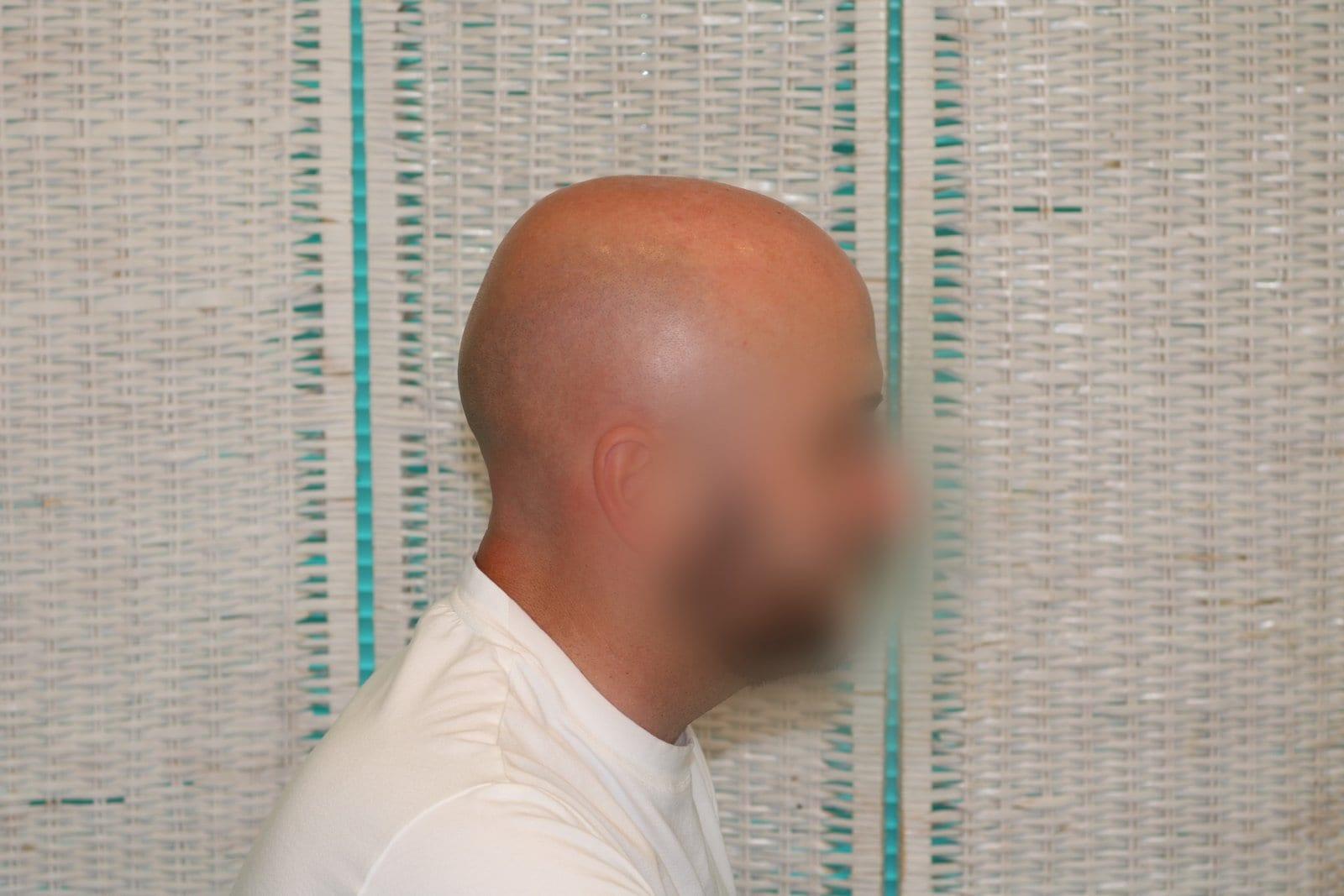 Prima: tricopigmentazione effetto rasato a Firenze — Caso Prima / Dopo #33 (foto 6)