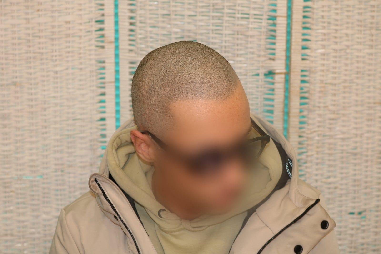Dopo: tricopigmentazione effetto rasato a Firenze — Caso Prima / Dopo #35 (foto 2)