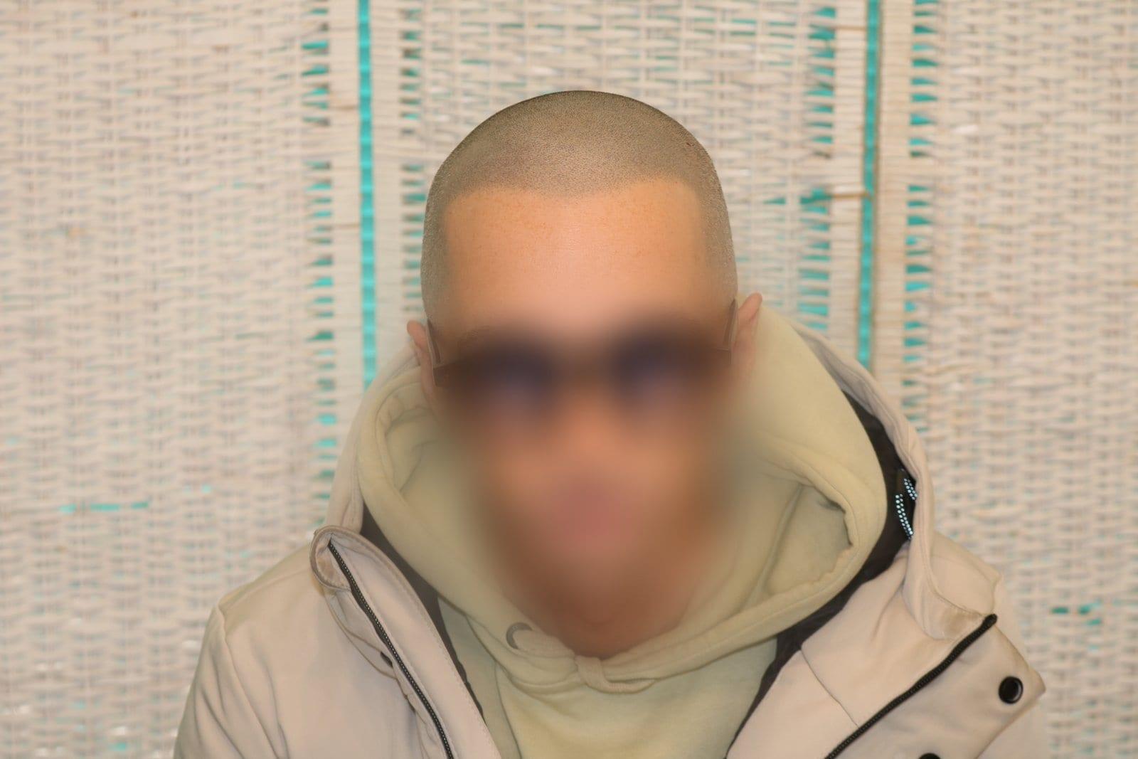 Dopo: tricopigmentazione effetto rasato a Firenze — Caso Prima / Dopo #35 (foto 3)