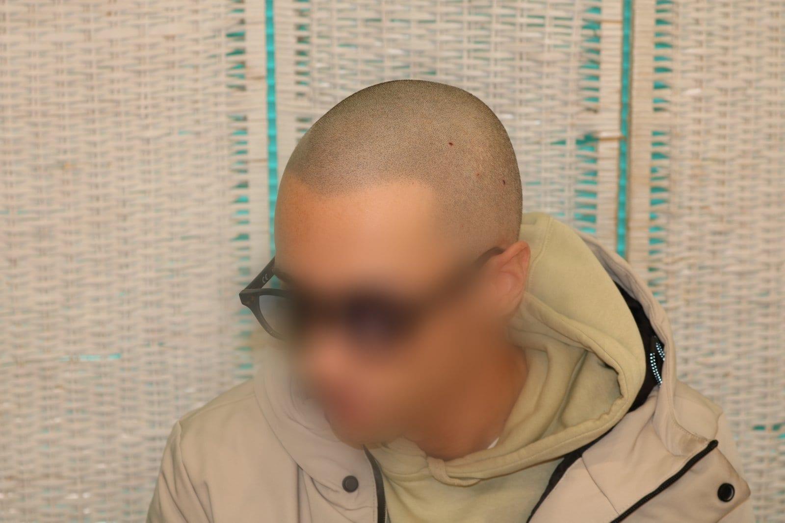 Dopo: tricopigmentazione effetto rasato a Firenze — Caso Prima / Dopo #35 (foto 4)