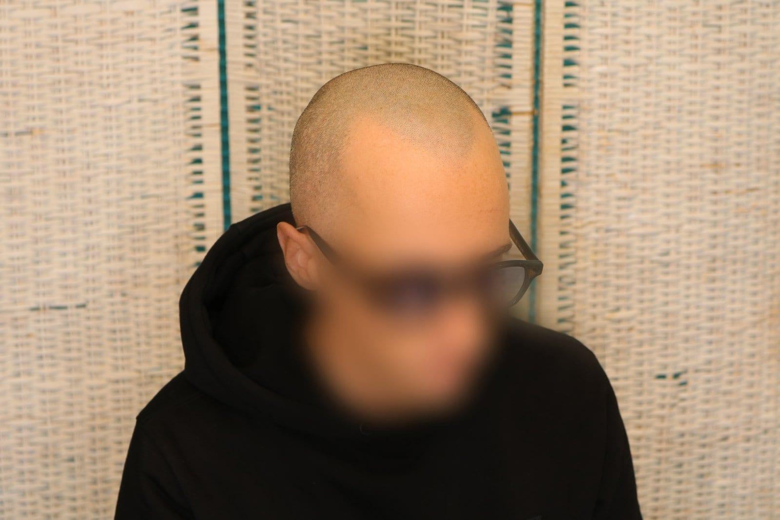 Prima: tricopigmentazione effetto rasato a Firenze — Caso Prima / Dopo #35 (foto 1)