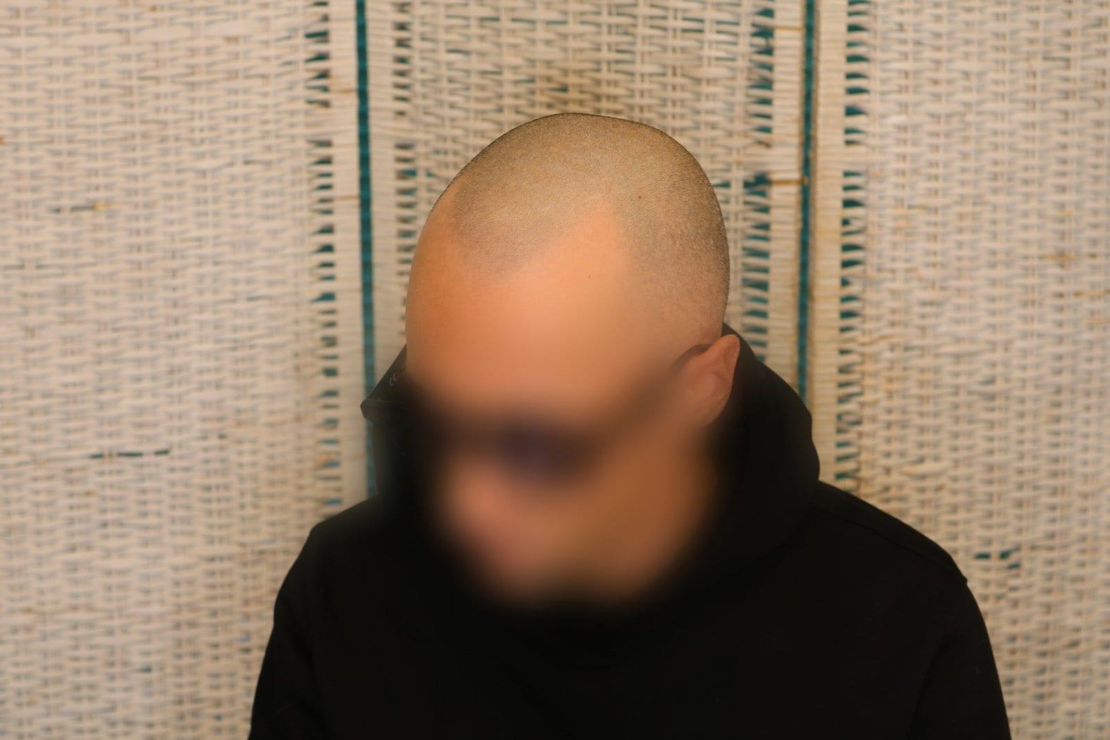 Prima: tricopigmentazione effetto rasato a Firenze — Caso Prima / Dopo #35 (foto 2)