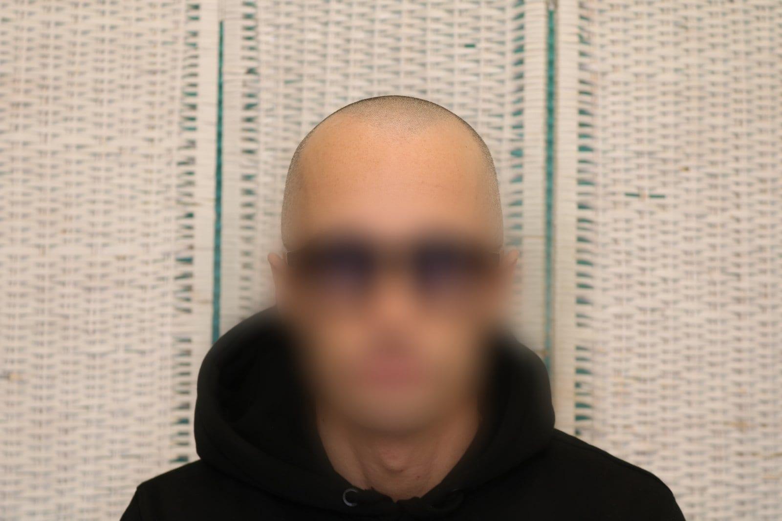 Prima: tricopigmentazione effetto rasato a Firenze — Caso Prima / Dopo #35 (foto 4)