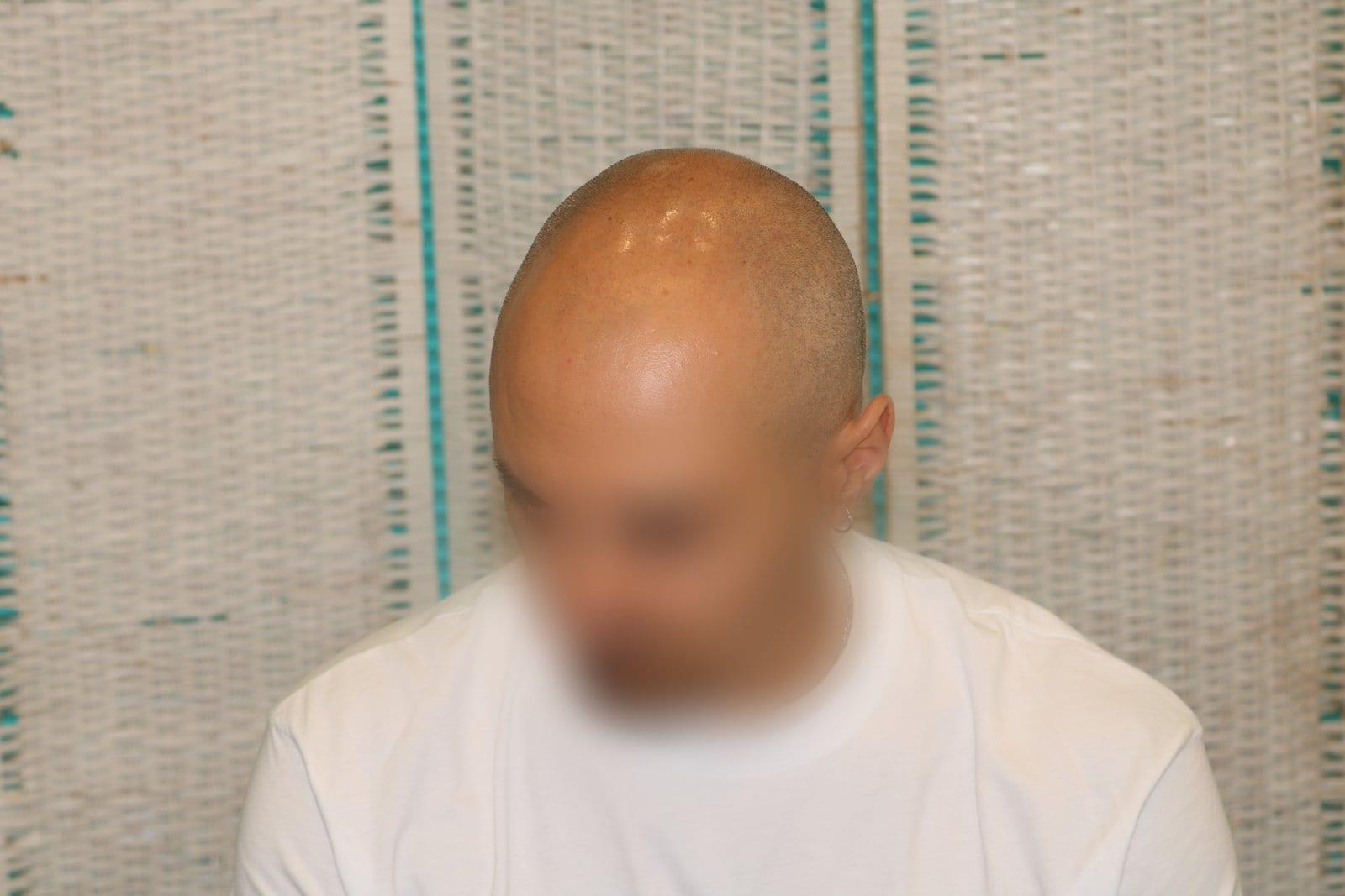 Prima: tricopigmentazione effetto rasato a Firenze — Caso Prima / Dopo #36 (foto 1)