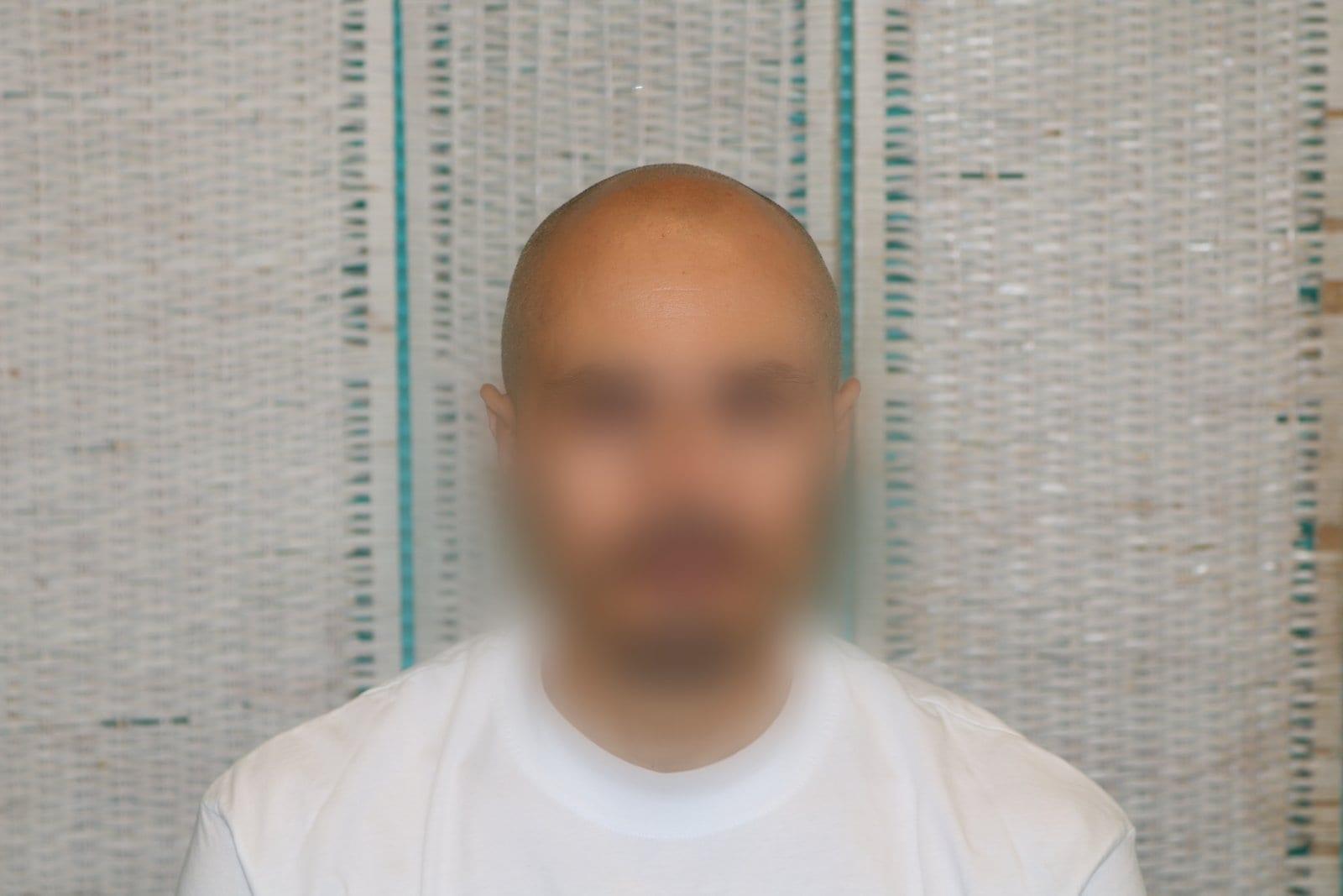 Prima: tricopigmentazione effetto rasato a Firenze — Caso Prima / Dopo #36 (foto 2)