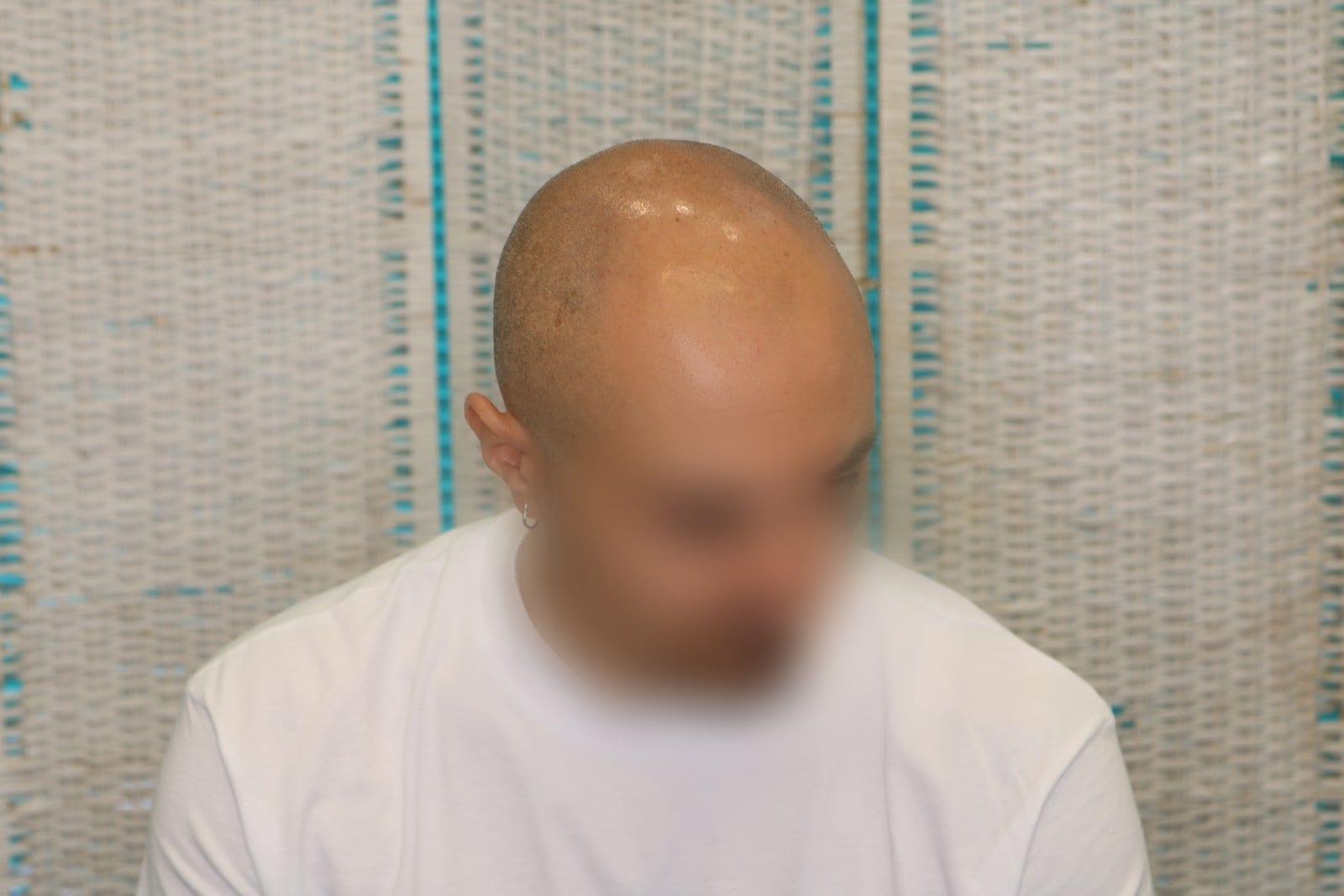 Prima: tricopigmentazione effetto rasato a Firenze — Caso Prima / Dopo #36 (foto 3)